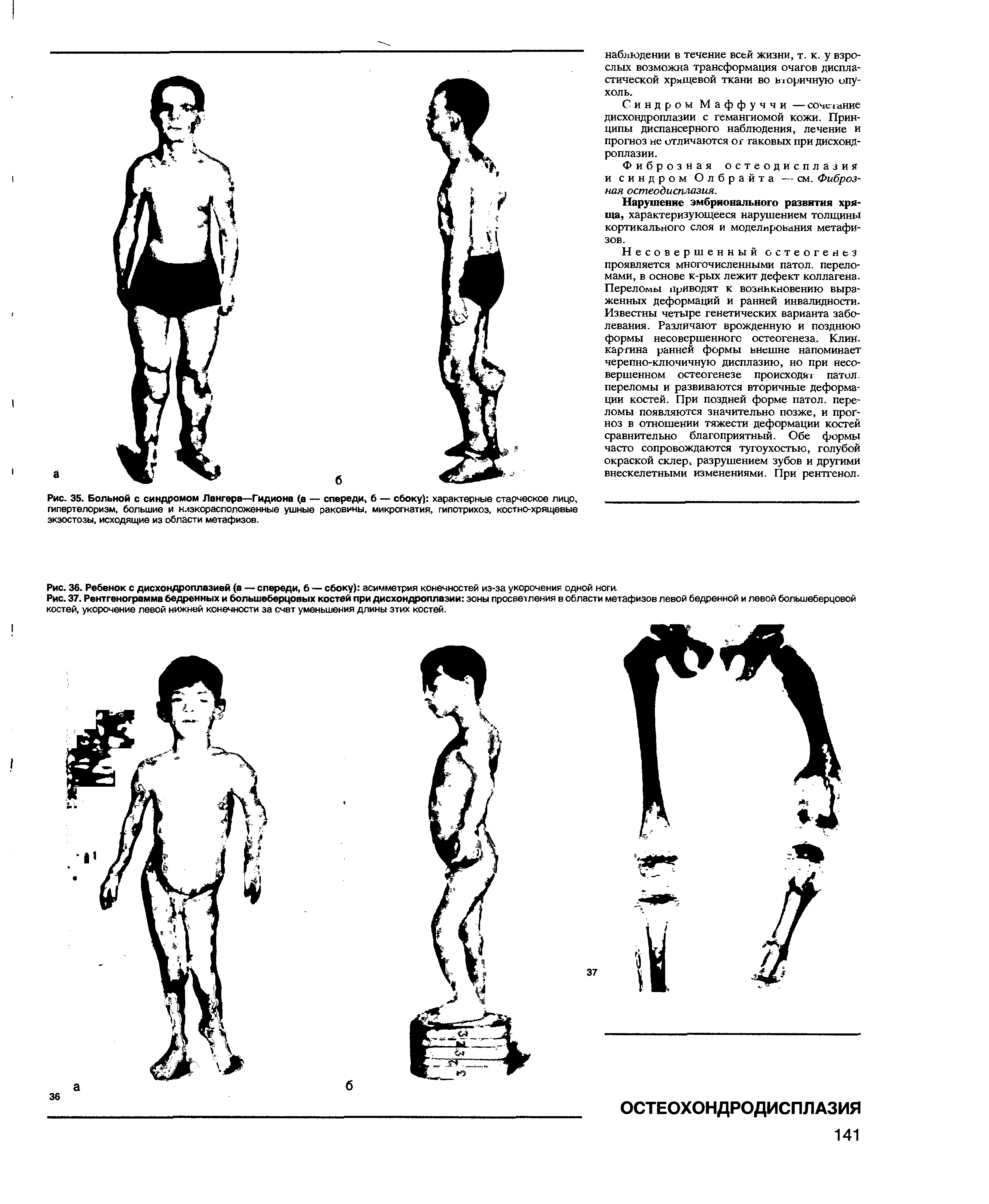 Рис. 36. Ребенок с дисхондроплазией (а — спереди, б — сбоку) асимметрия конечностей из-за укорочения одной ноги...