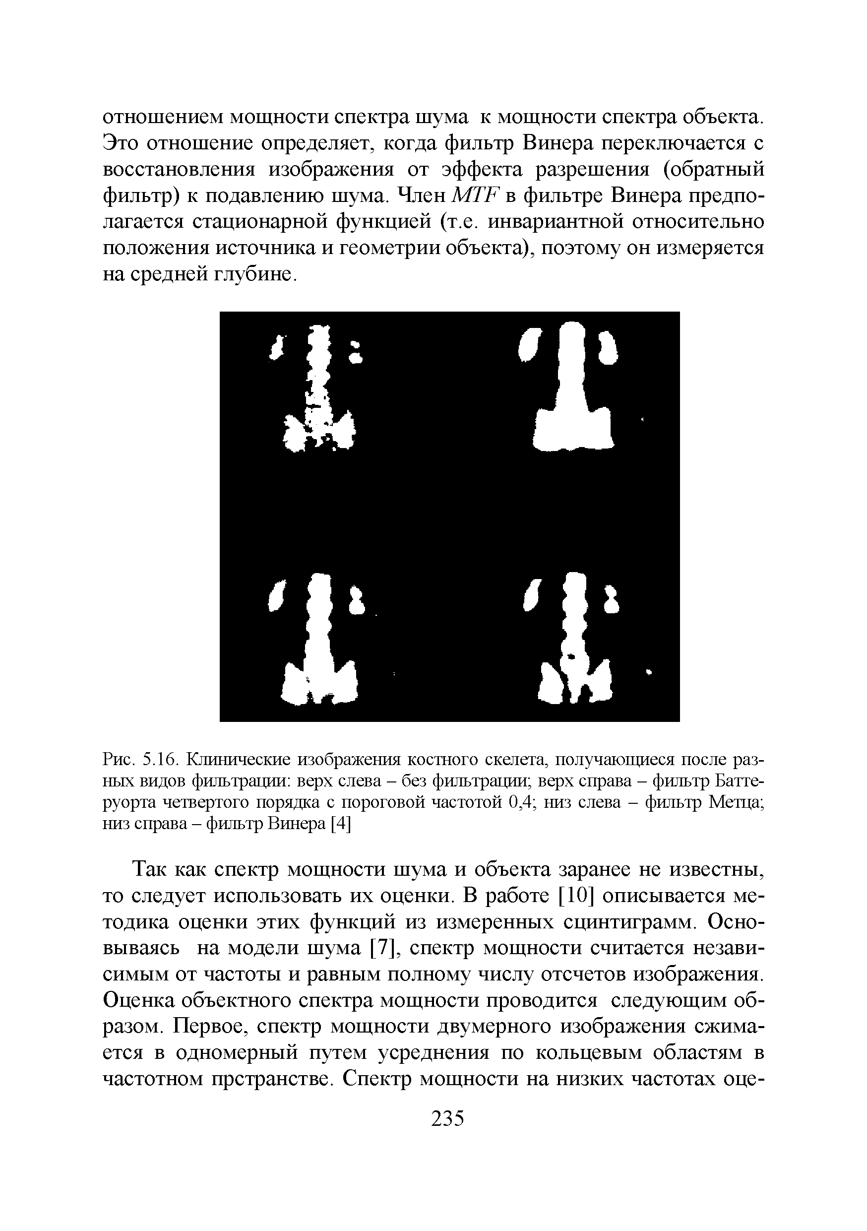Рис. 5.16. Клинические изображения костного скелета, получающиеся после разных видов фильтрации верх слева - без фильтрации верх справа - фильтр Батте-руорта четвертого порядка с пороговой частотой 0,4 низ слева - фильтр Метца низ справа - фильтр Винера [4]...