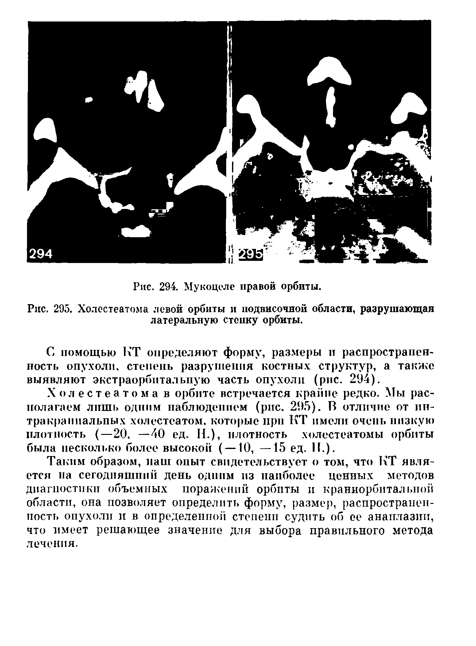 Рис. 295. Холестеатома левой орбиты и подвисочной области, разрушающая латеральную стоику орбиты.