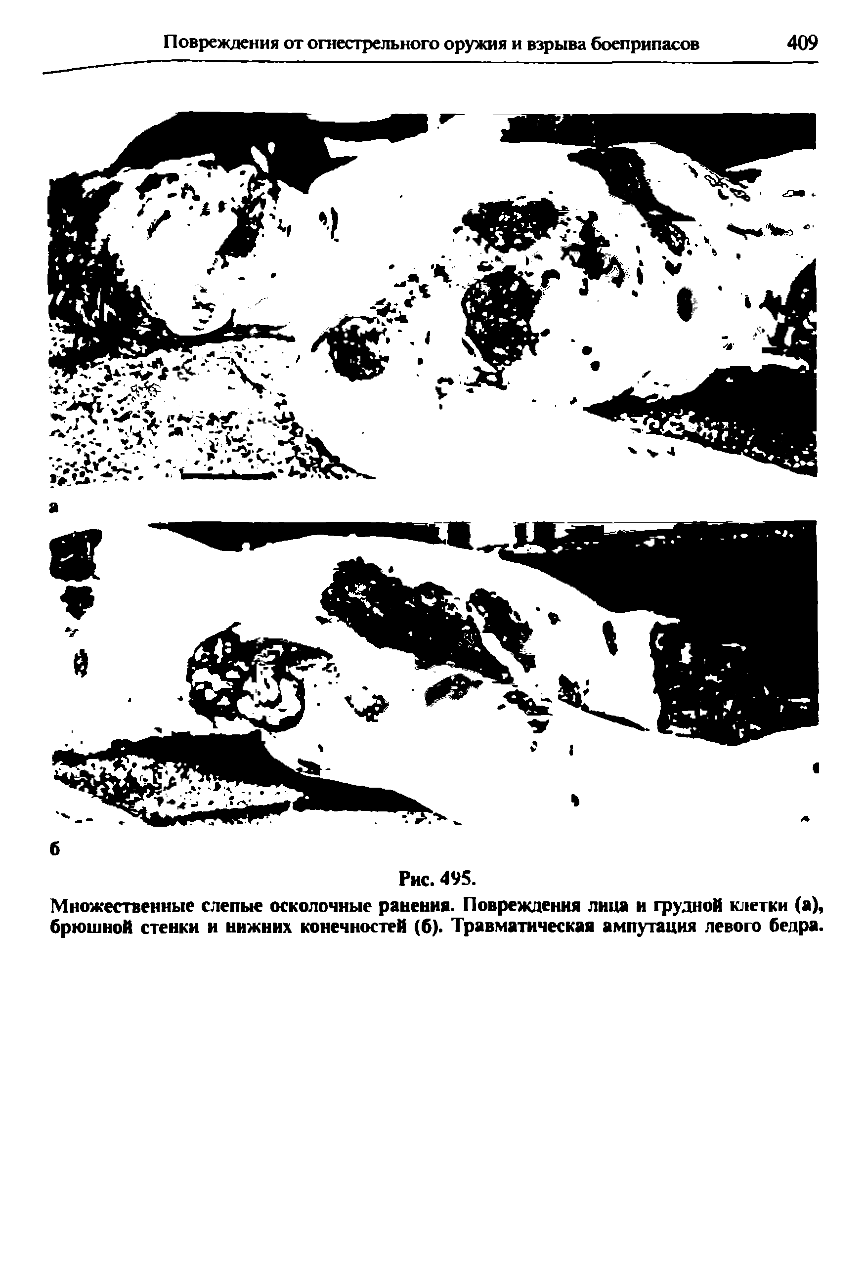 Рис. 495. Множественные слепые осколочные ранениа. Повреждения лица и грудной клетки (а), брюшной стенки и нижних конечностей (6). Травматическая ампутация левого бедра.