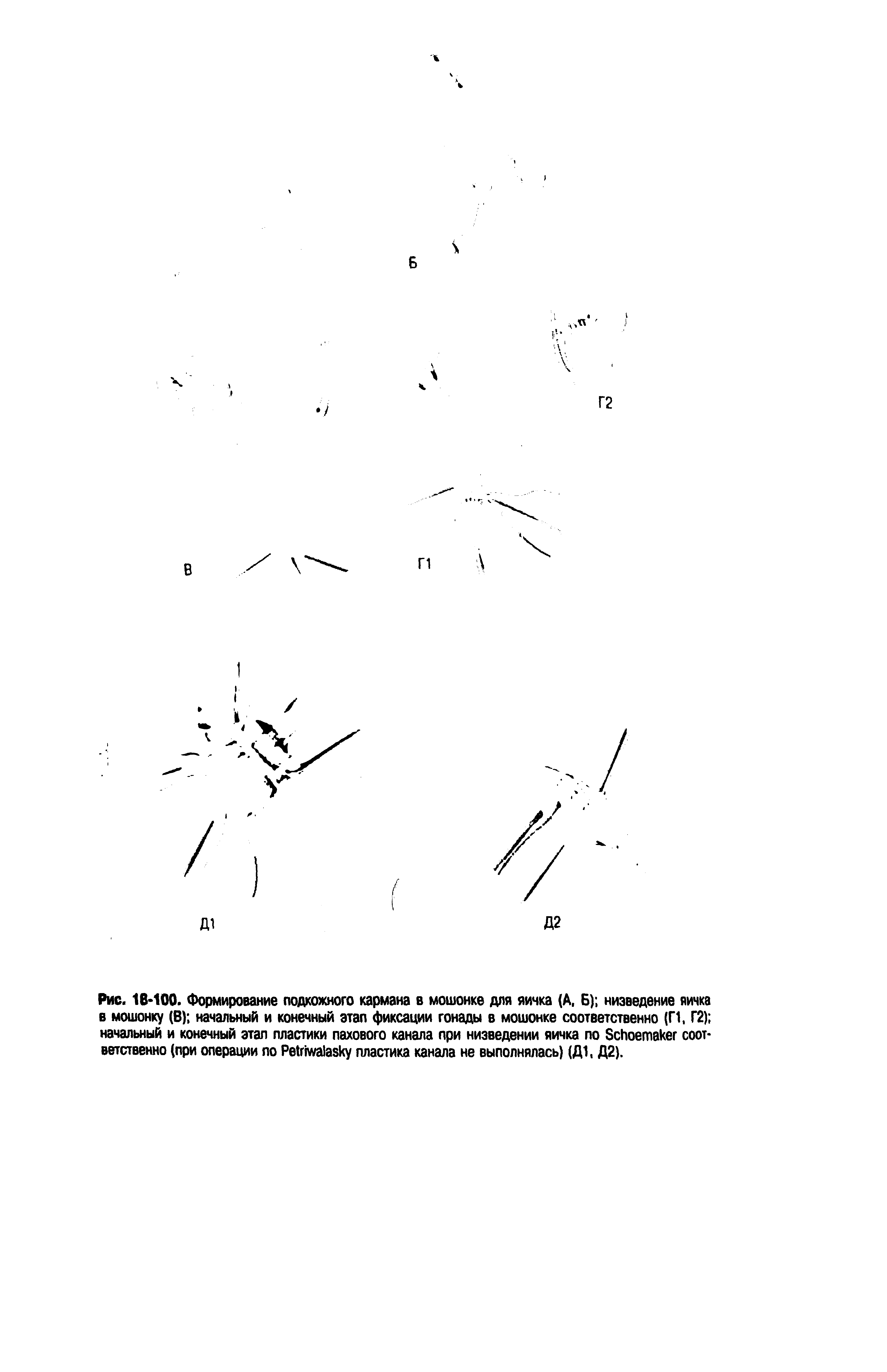 Рис. 18-100. Формирование подкожного кармана в мошонке для яичка (А. Б) низведение яичка в мошонку (В) начальный и конечный этап фиксации гонады в мошонке соответственно (Г1, Г2) начальный и конечный этап пластики пахового канала при низведении яичка по БсЬоетакег соответственно (при операции по Реима ку пластика канала не выполнялась) (Д1, Д2).