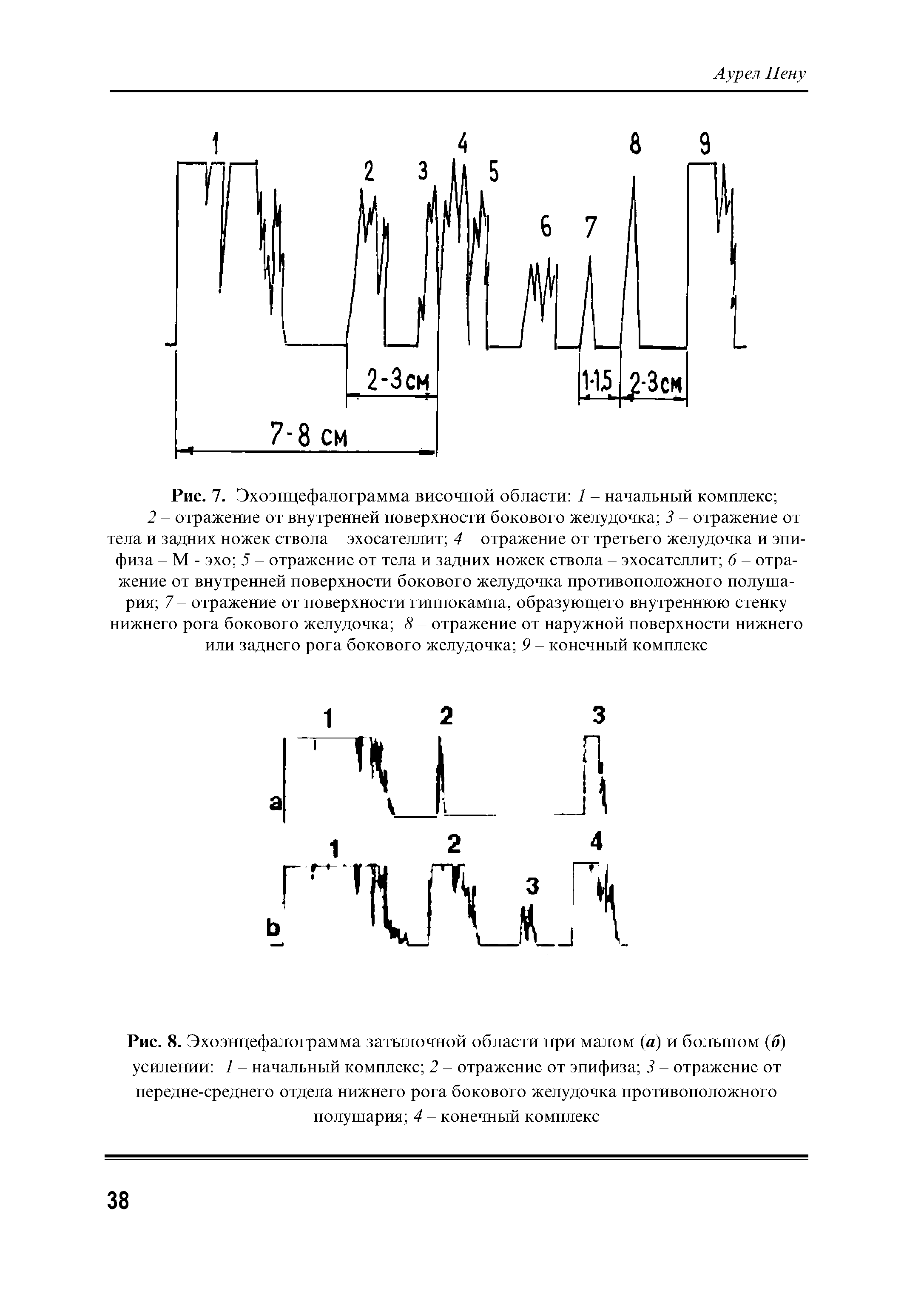 Рис. 8. Эхоэнцефалограмма затылочной области при малом (а) и большом (б) усилении 1 - начальный комплекс 2 - отражение от эпифиза 3 - отражение от передне-среднего отдела нижнего рога бокового желудочка противоположного полушария 4 - конечный комплекс...