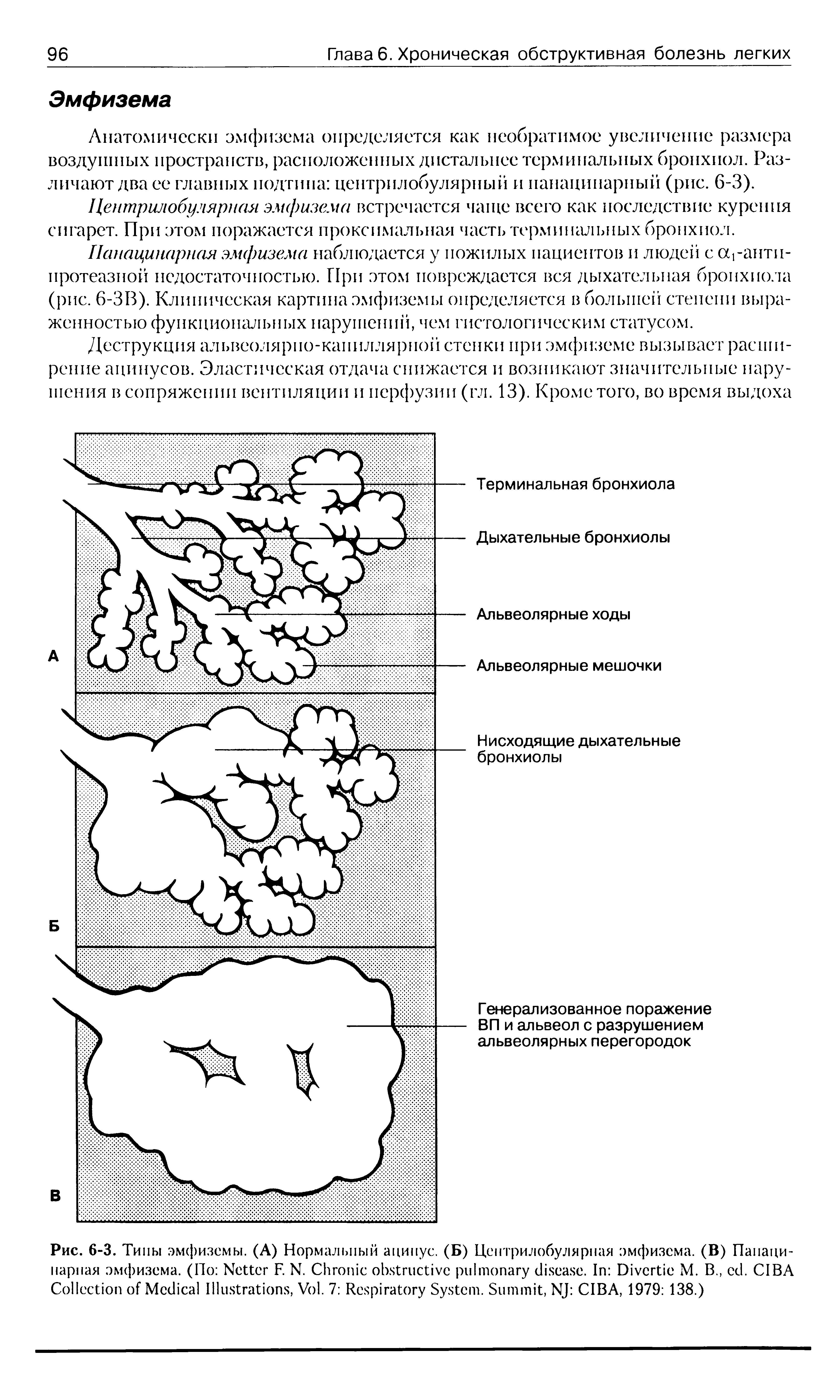 Рис. 6-3. Типы эмфиземы. (А) Нормальный ацинус. (Б) Центрилобулярная эмфизема. (В) Панацинарная эмфизема. (По N F. N. C . I D M. B., . CIBA C M I , V . 7 R S . S , NJ CIBA, 1979 138.)...