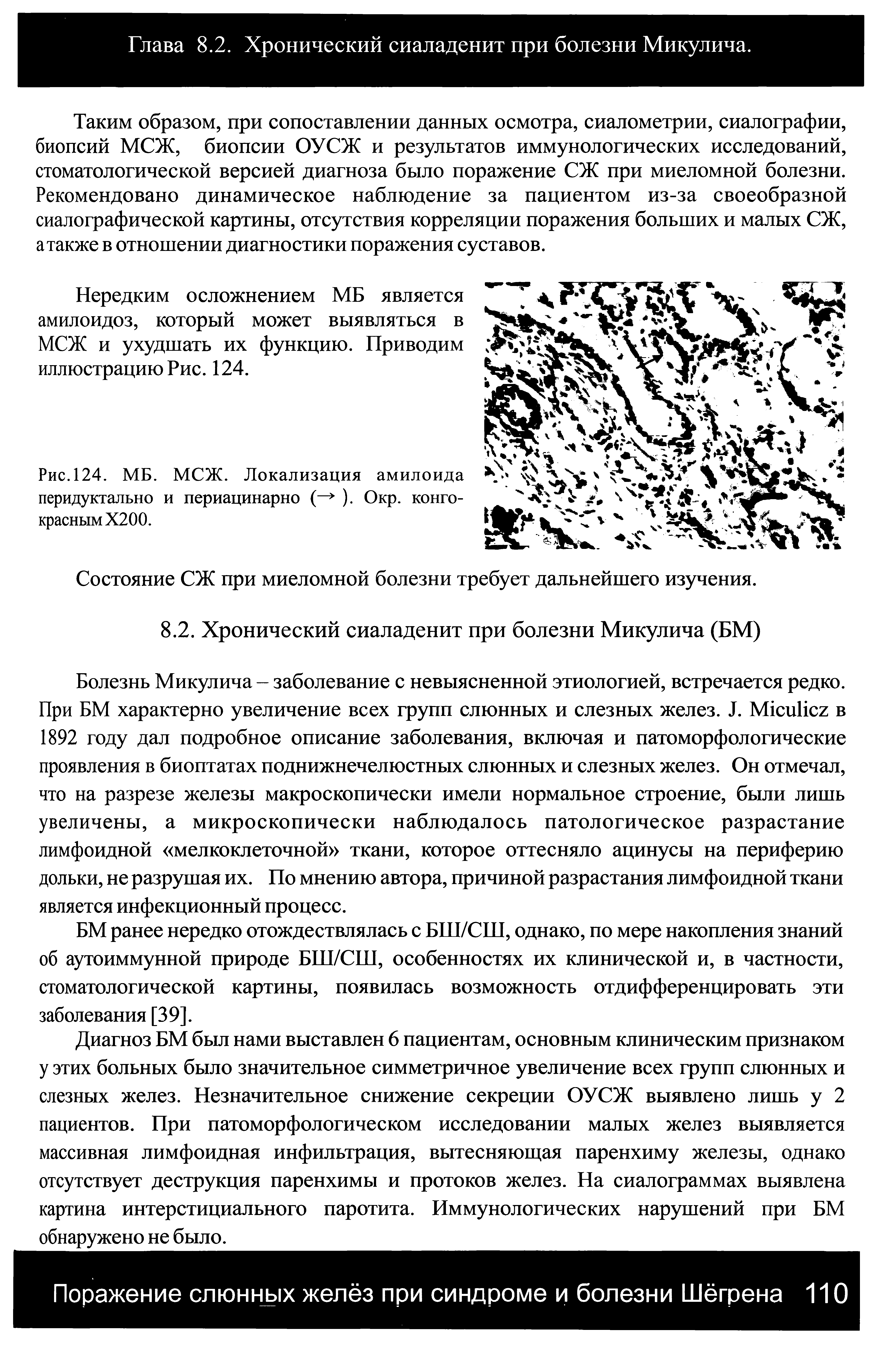 Рис. 124. МБ. МСЖ. Локализация амилоида перидуктально и периацинарно (— ). Окр. конго-красным Х200.