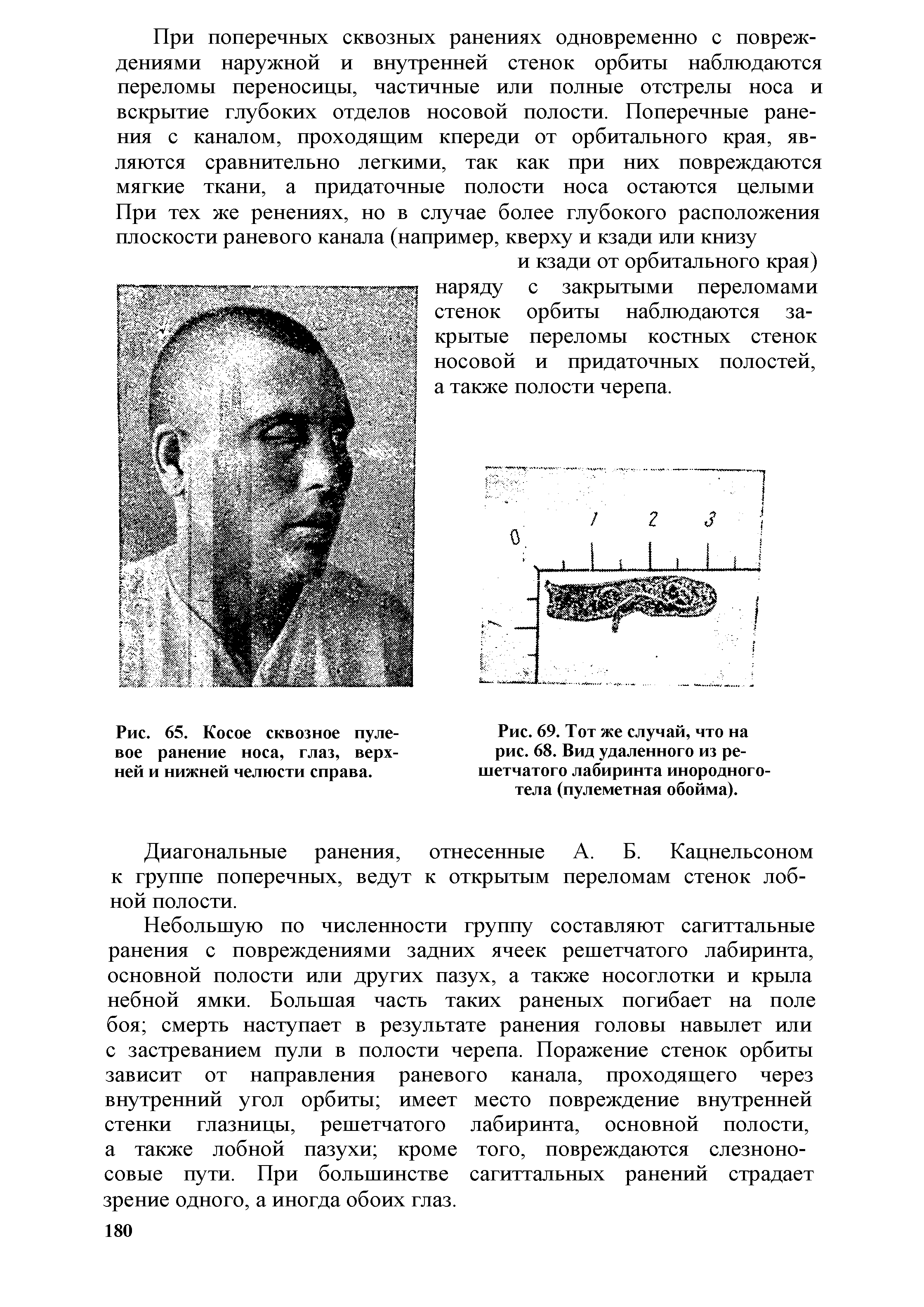 Рис. 69. Тот же случай, что на рис. 68. Вид удаленного из решетчатого лабиринта инородного-тела (пулеметная обойма).