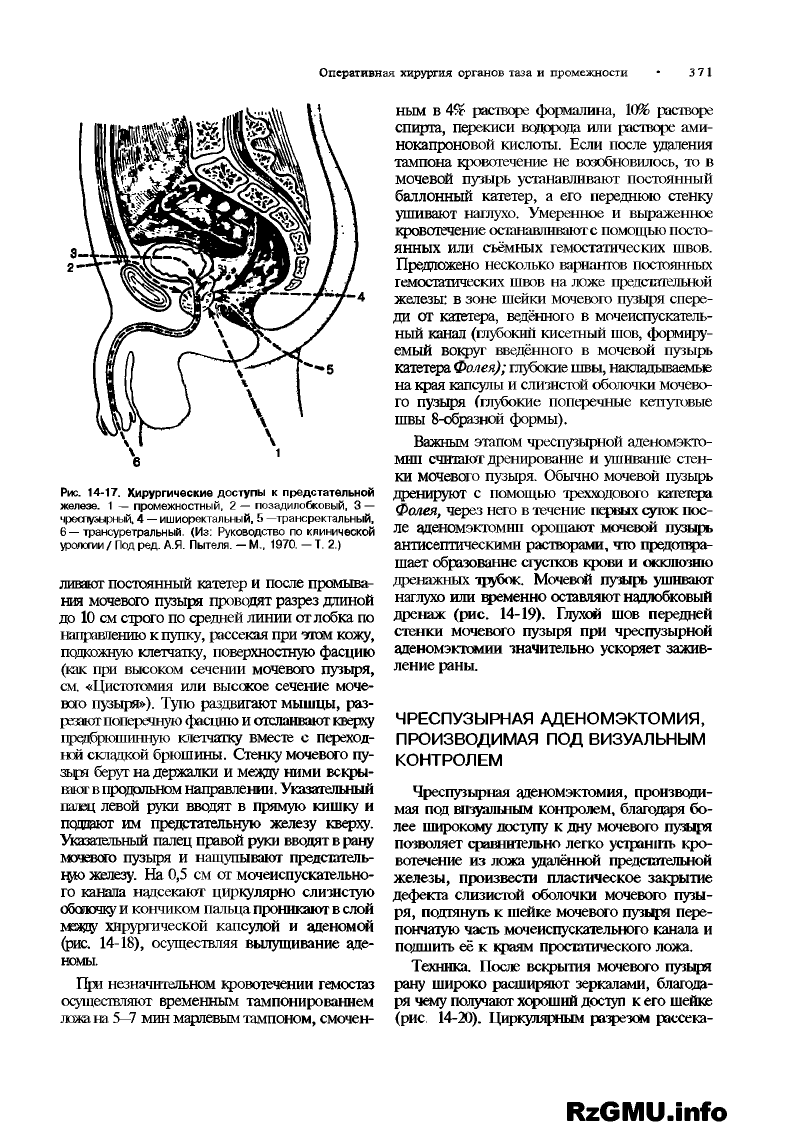 Рис. 14-17. Хирургические доступы к предстательной железе. 1 — промежностный, 2 — позадилобковый, 3 — чреспузырный, 4 — ишиоректальный, 5 —трансректальный, 6 —трансуретральный. (Из Руководство по клинической уролопии / Под ред. А.Я. Пытеля. — М., 1970. — Т. 2.)...