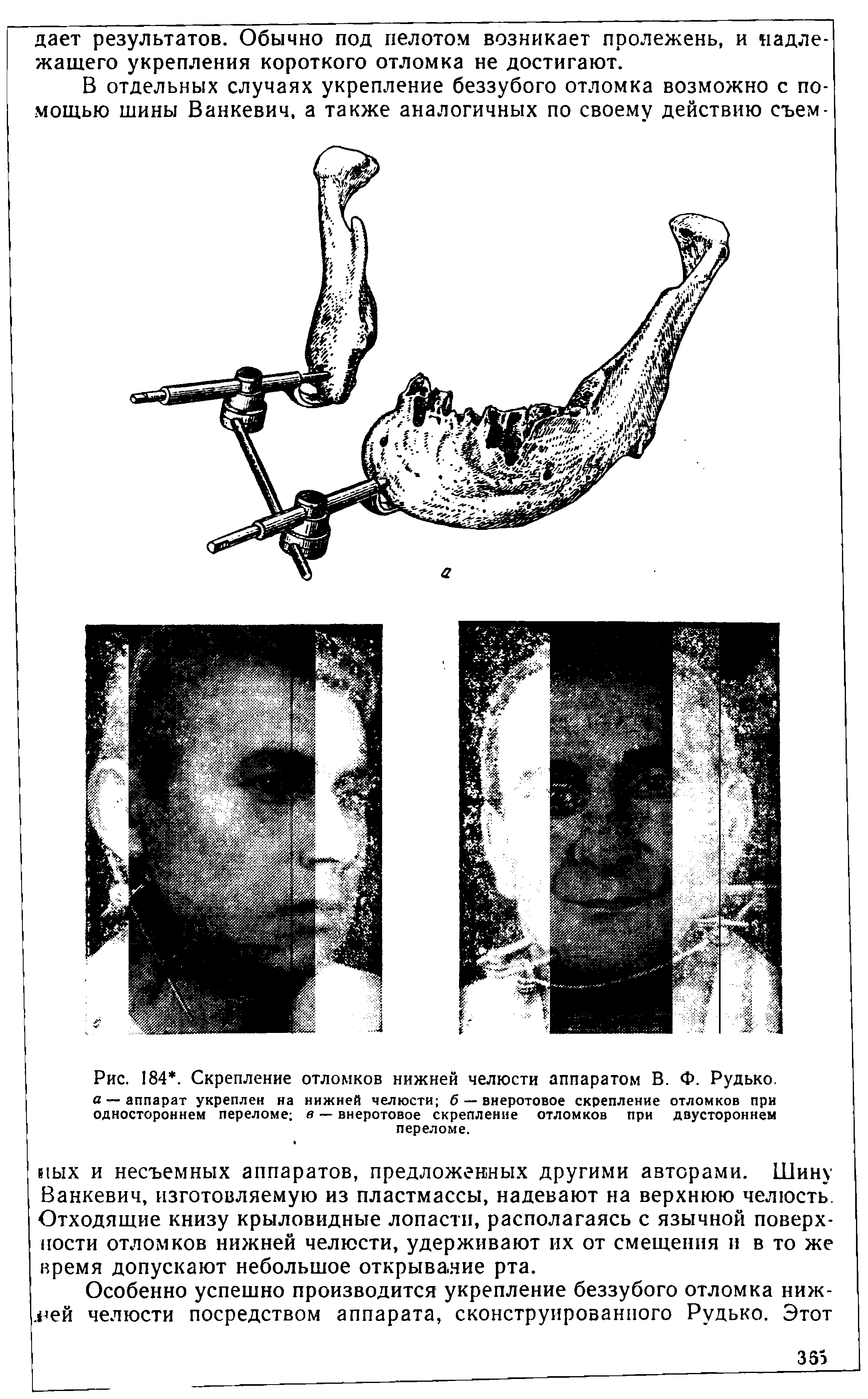 Рис. 184. Скрепление а — аппарат укреплен на одностороннем переломе отломков нижней челюсти аппаратом В. Ф. Рудько. нижней челюсти б — внеротовое скрепление отломков при в — внеротовое скрепление отломков при двустороннем переломе.