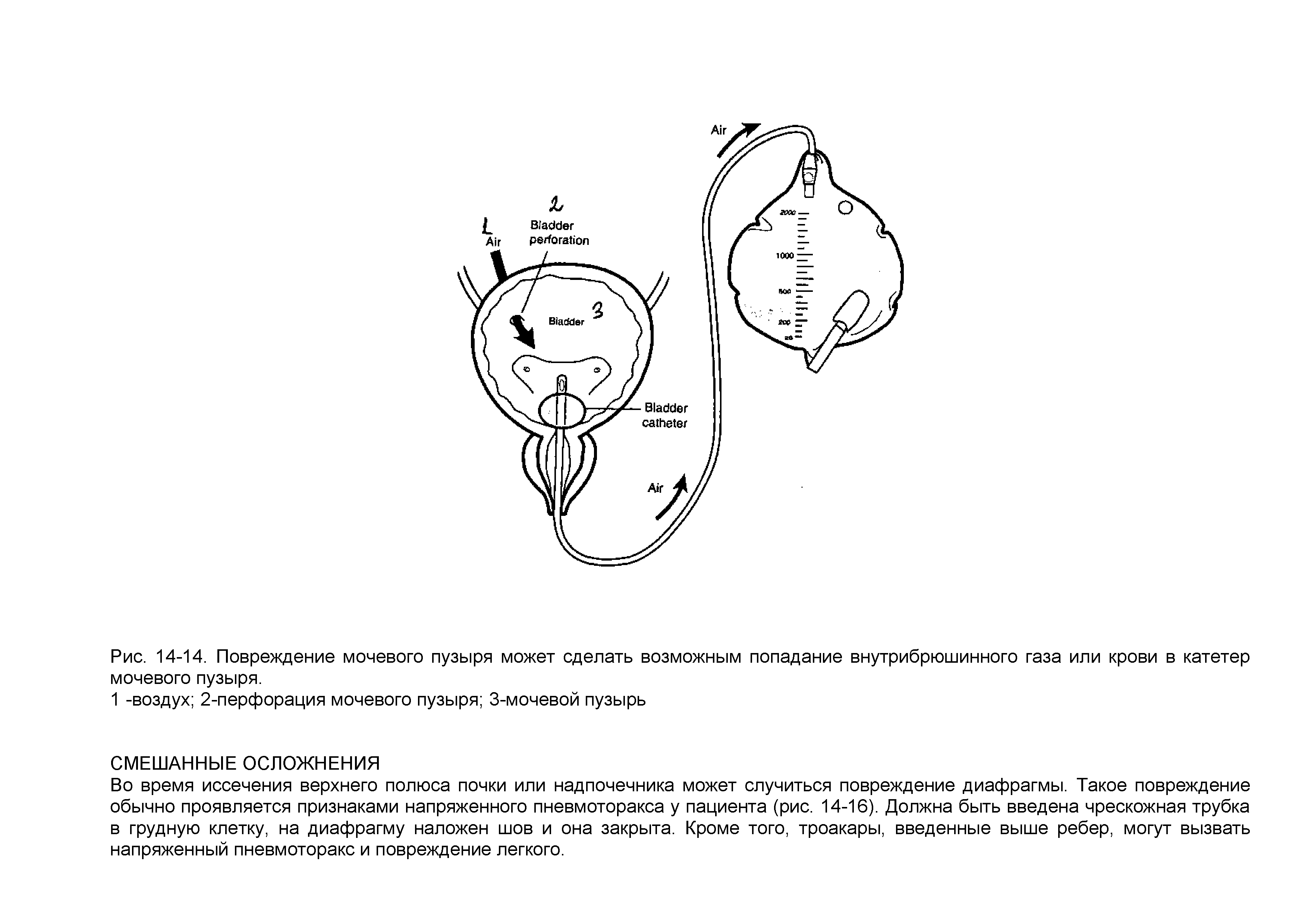Рис. 14-14. Повреждение мочевого пузыря может сделать возможным попадание внутрибрюшинного газа или крови в катетер мочевого пузыря.