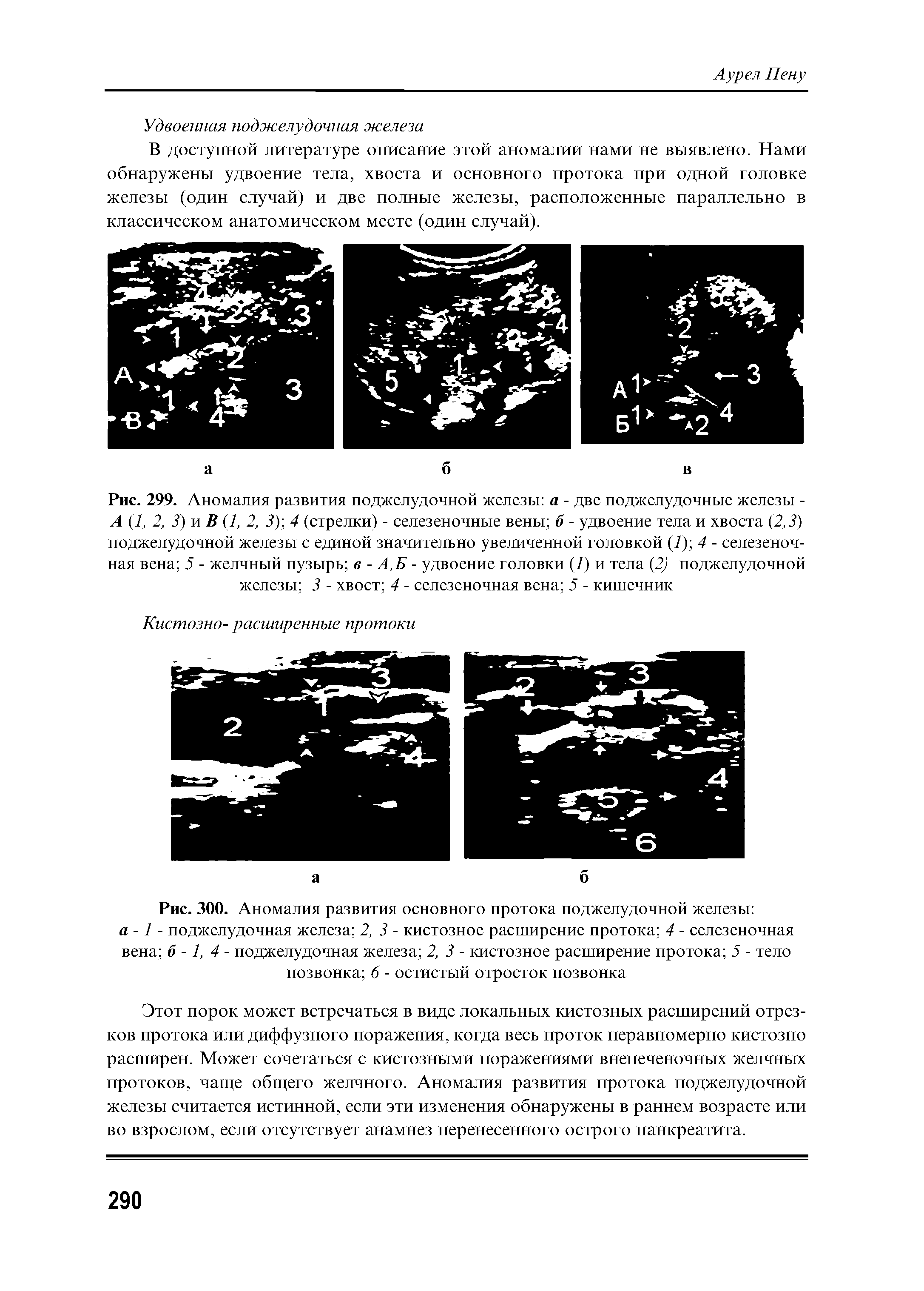Рис. 299. Аномалия развития поджелудочной железы а - две поджелудочные железы -А (7, 2, 3) и В (7, 2, 3) 4 (стрелки) - селезеночные вены б - удвоение тела и хвоста (2,3) поджелудочной железы с единой значительно увеличенной головкой (7) 4 - селезеночная вена 5 - желчный пузырь в - А,Б - удвоение головки (7) и тела (2) поджелудочной железы 3 - хвост 4 - селезеночная вена 5 - кишечник...