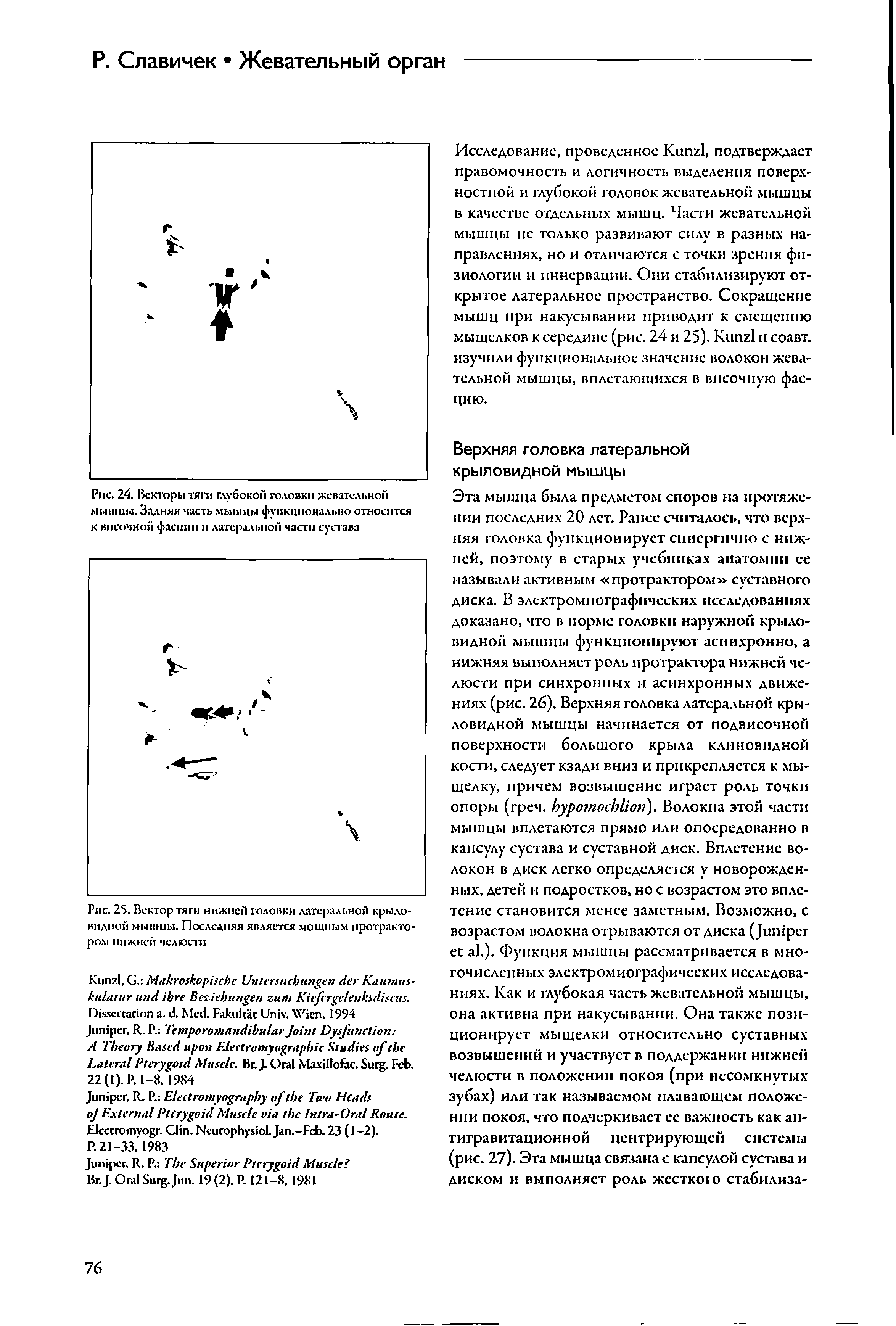 Рис. 24. Векторы тяги глубокой головки жевательной мышцы. Задняя часть мышцы функционально относится к височной фасции и латеральной части сустава...