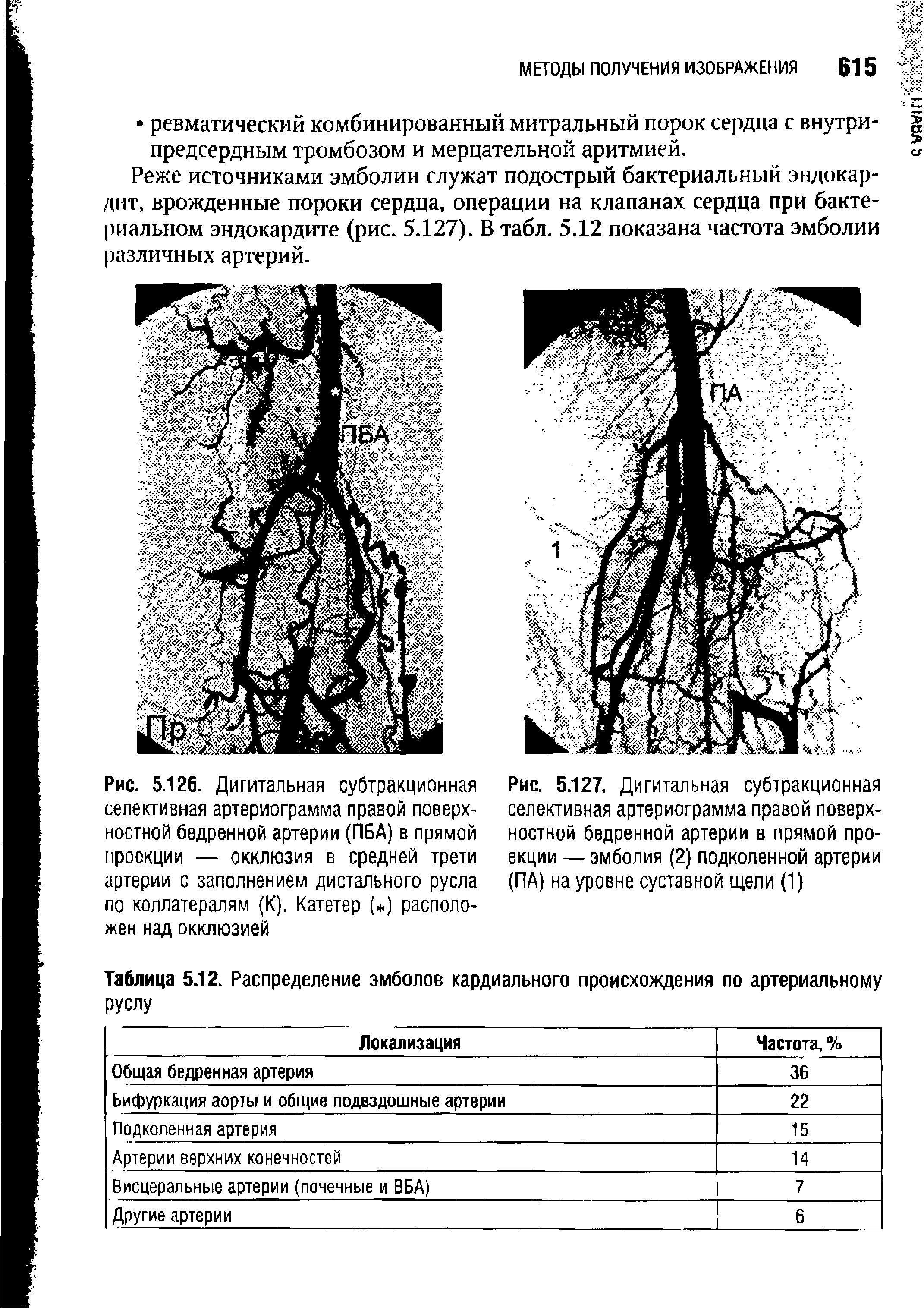 Таблица 5.12. Распределение эмболов кардиального происхождения по артериальному руслу...