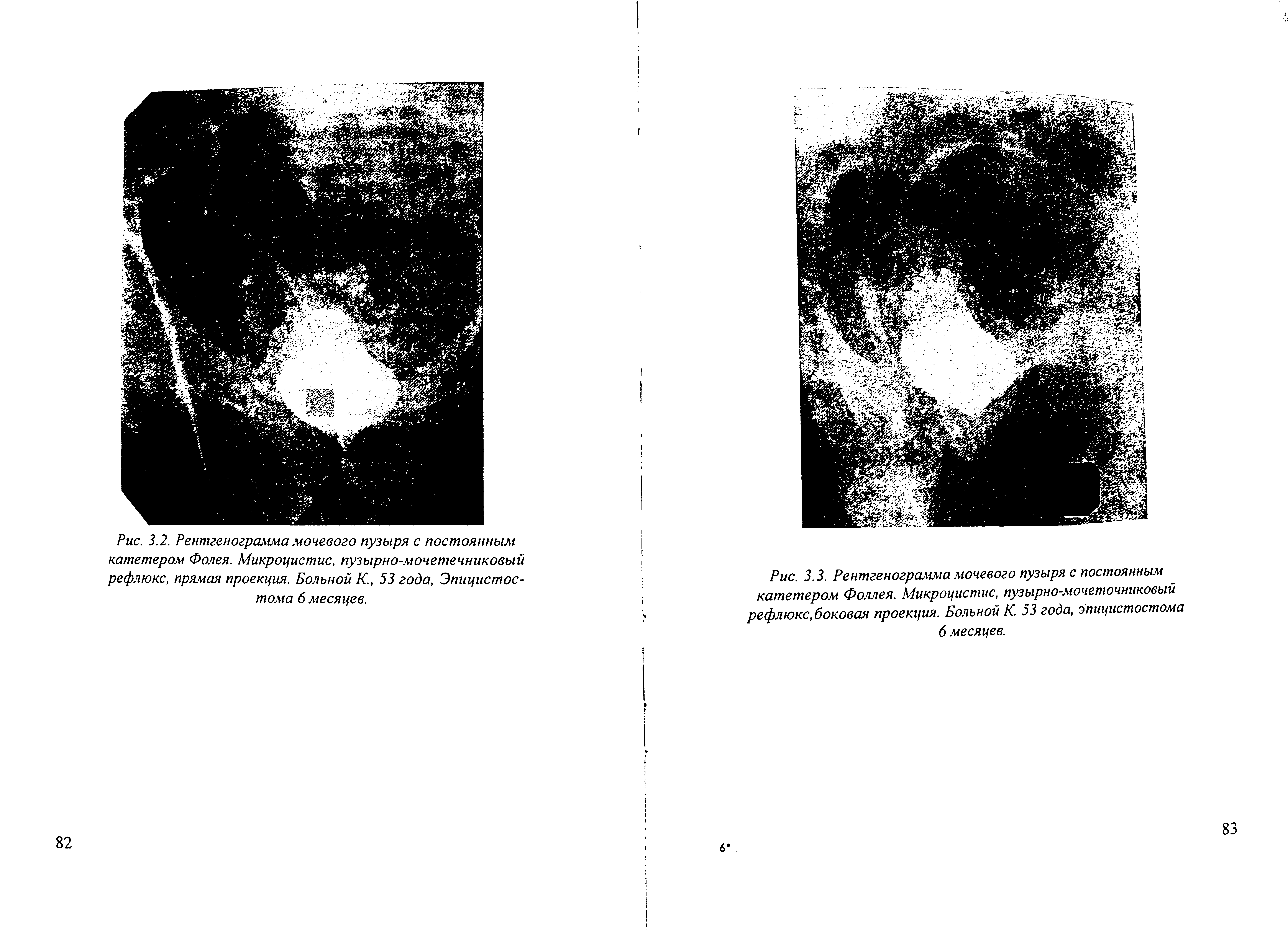 Рис. 3.3. Рентгенограмма мочевого пузыря с постоянным катетером Фоллея. Микроцистис, пузырно-мочеточниковый рефлюкс, боковая проекция. Больной К. 53 года, эпицистостома 6 месяцев.