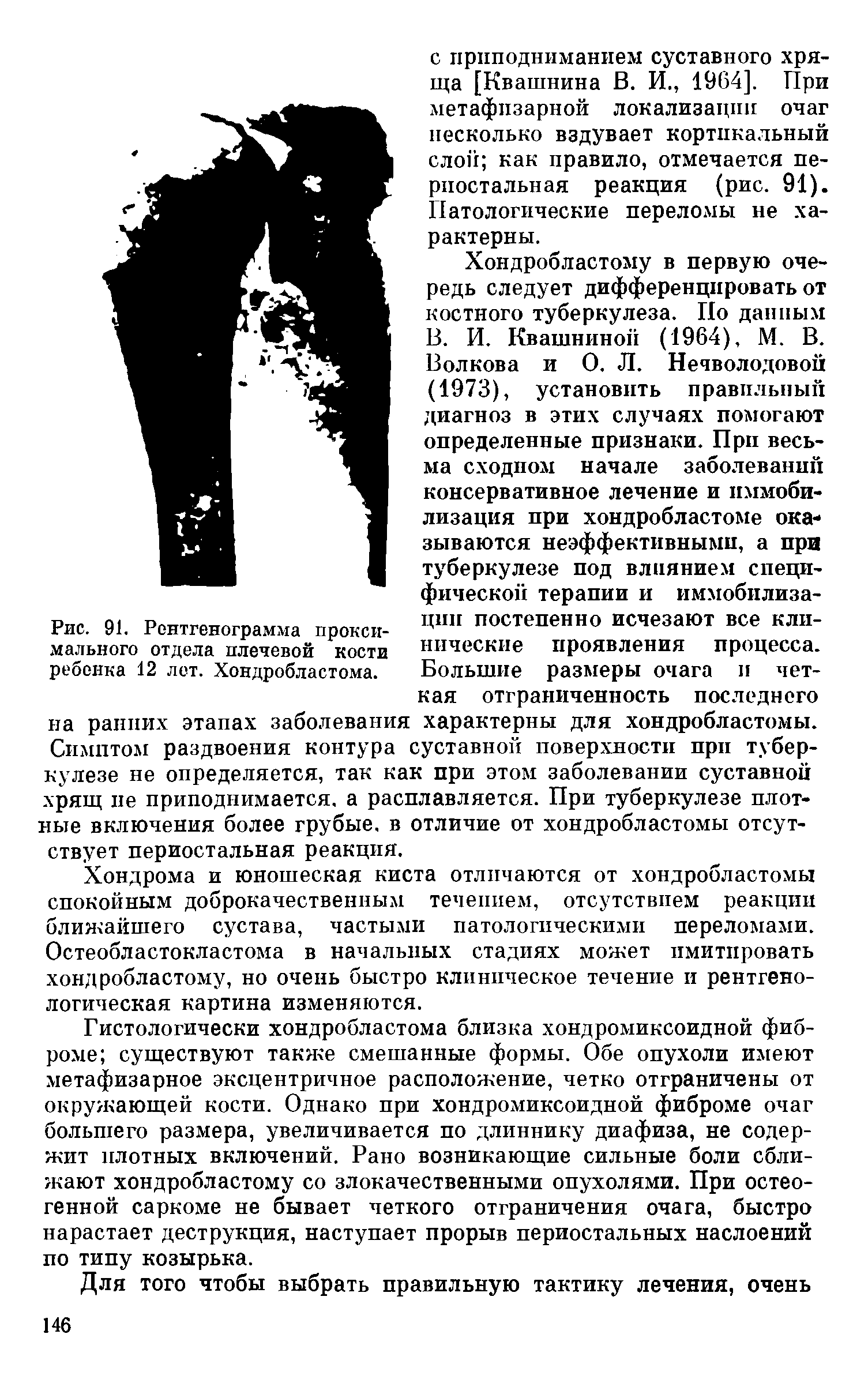 Рис. 91. Рентгенограмма проксимального отдела плечевой кости ребенка 12 лет. Хондробластома.