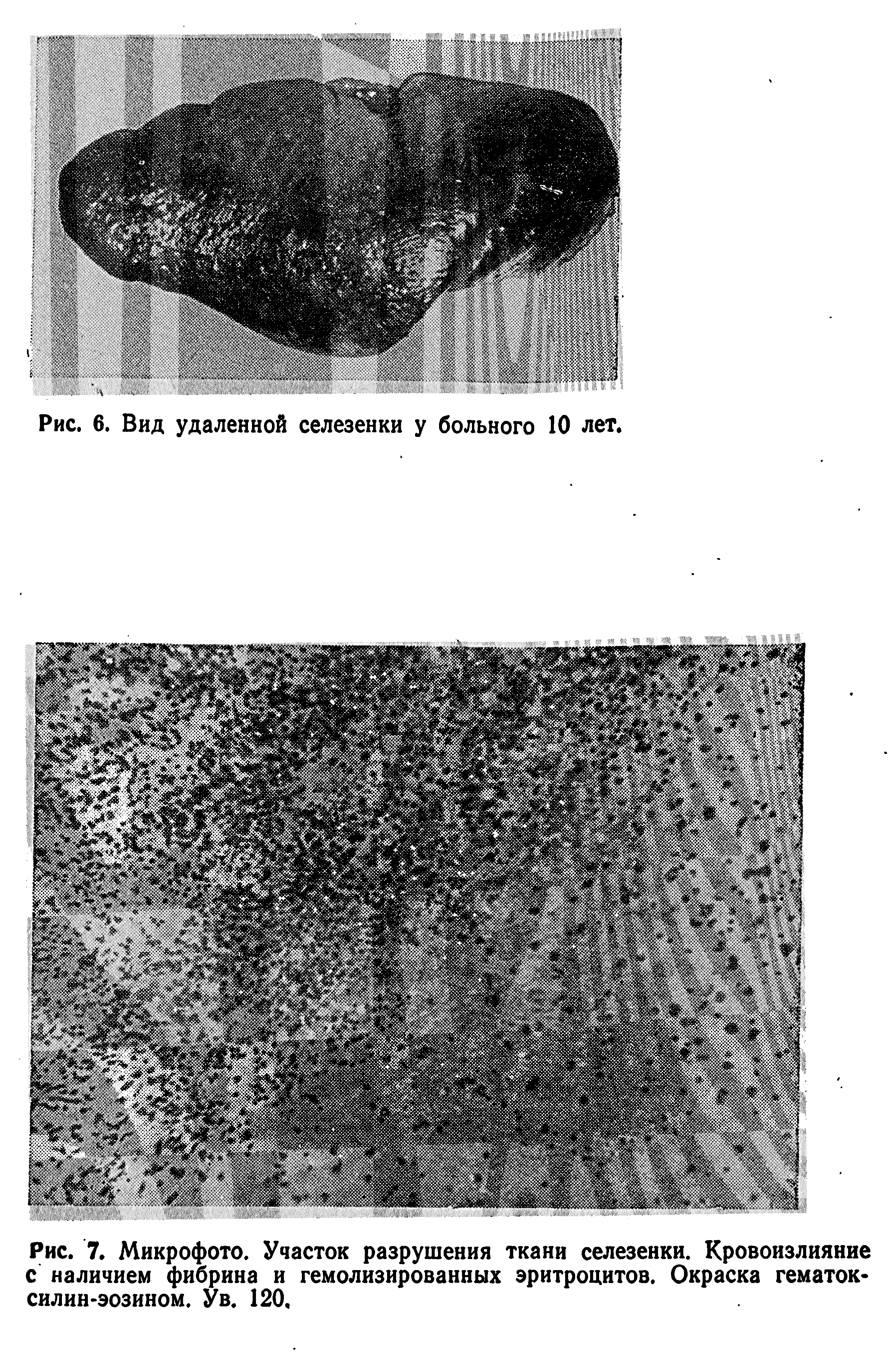 Рис. 7. Микрофото. Участок разрушения ткани селезенки. Кровоизлияние с наличием фибрина и гемолизированных эритроцитов. Окраска гематок-силин-эозином. У в. 120.