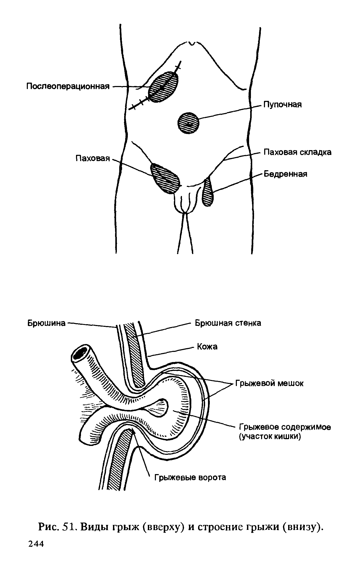 Рис. 51. Виды грыж (вверху) и строение грыжи (внизу).