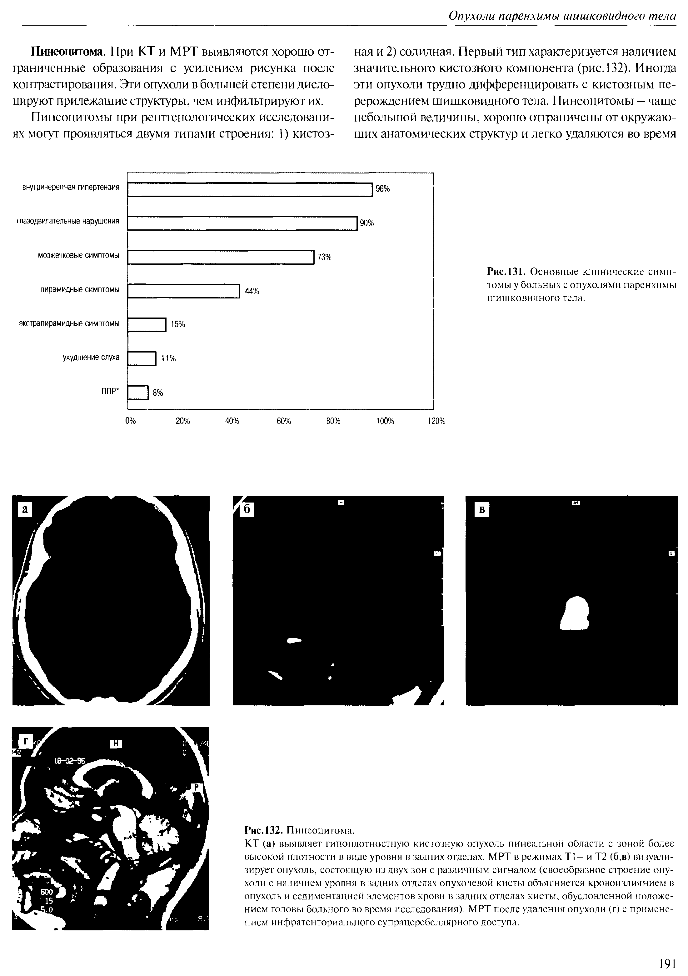 Рис.131. Основные клинические симптомы у больных с опухолями паренхимы шишковидного тела.
