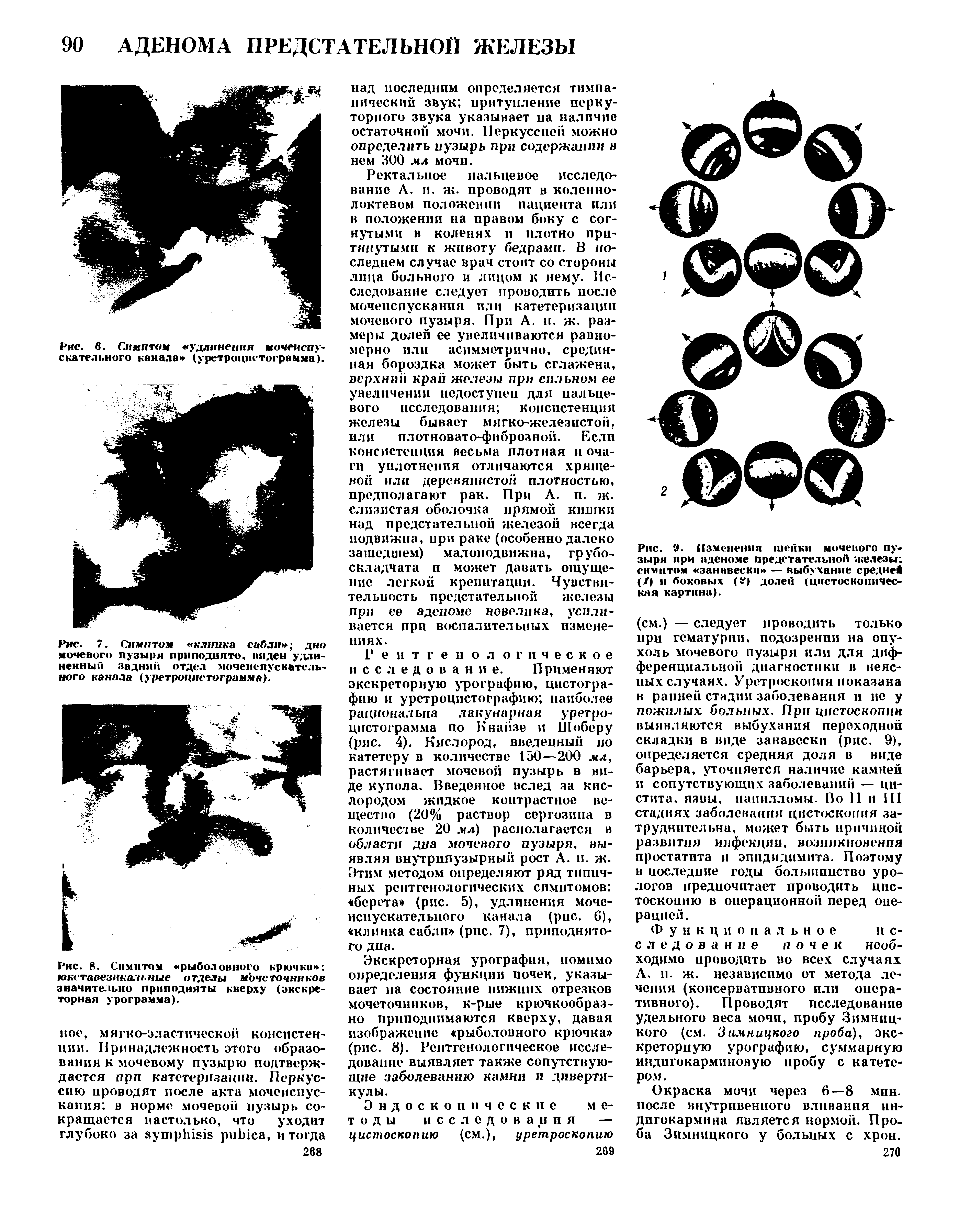 Рис. 8. Симптом рыболовного крючка юкставезнкальные отделы мЪчсточннков значительно приподняты кверху (экскреторная урограмма).