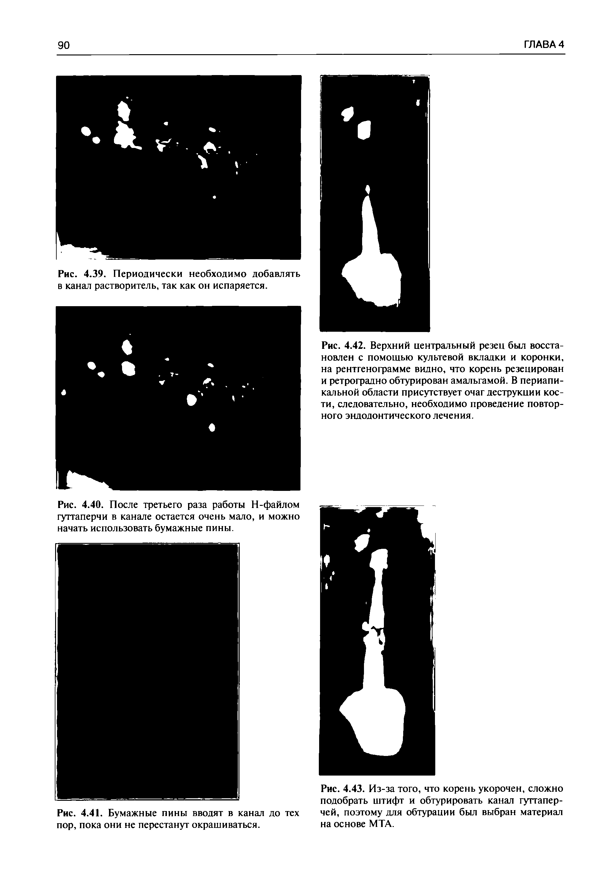 Рис. 4.43. Из-за того, что корень укорочен, сложно подобрать штифт и обтурировать канал гуттаперчей, поэтому для обтурации был выбран материал на основе МТА.