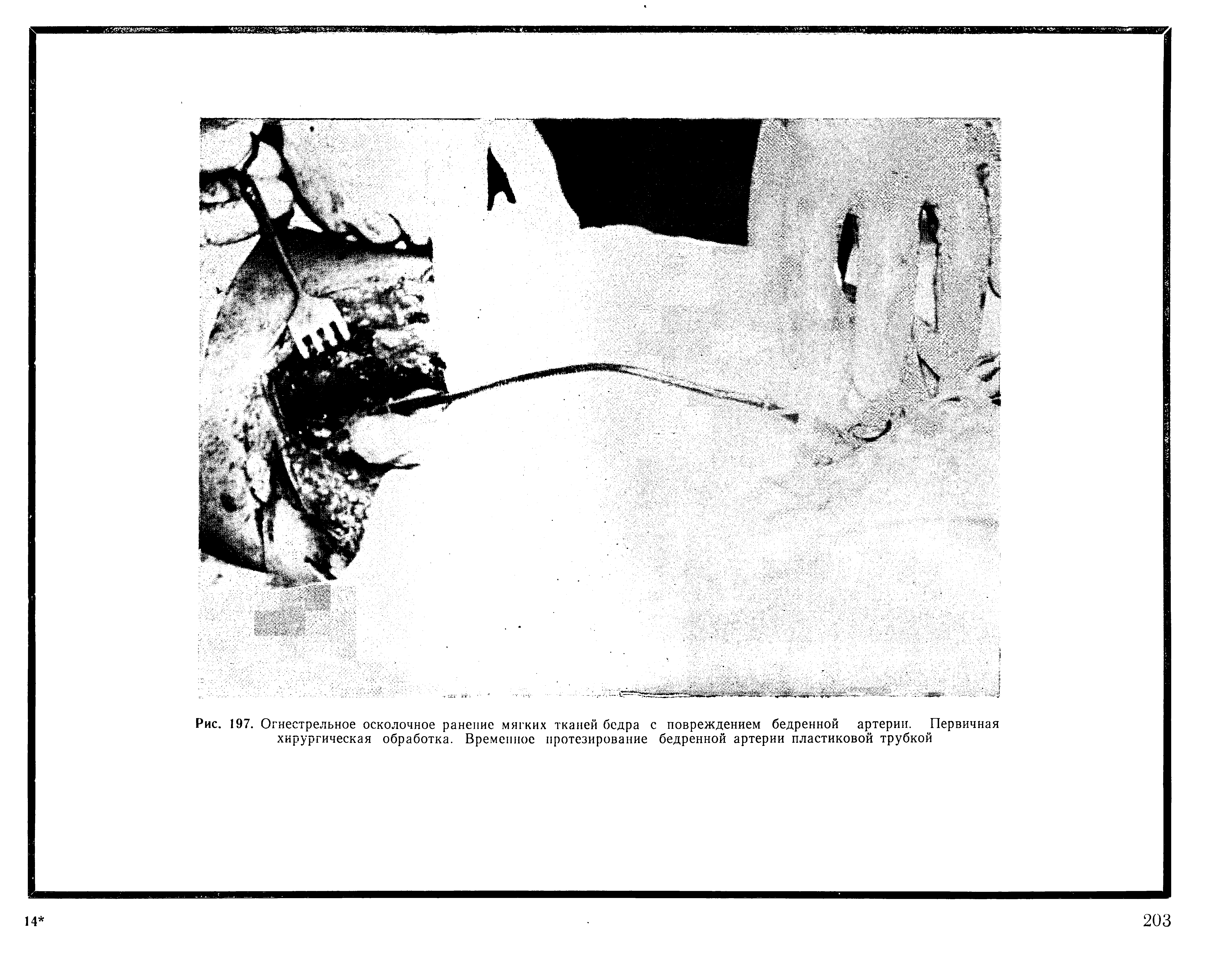 Рис. 197. Огнестрельное осколочное ранение мягких тканей бедра с повреждением бедренной артерии. Первичная хирургическая обработка. Временное протезирование бедренной артерии пластиковой трубкой...