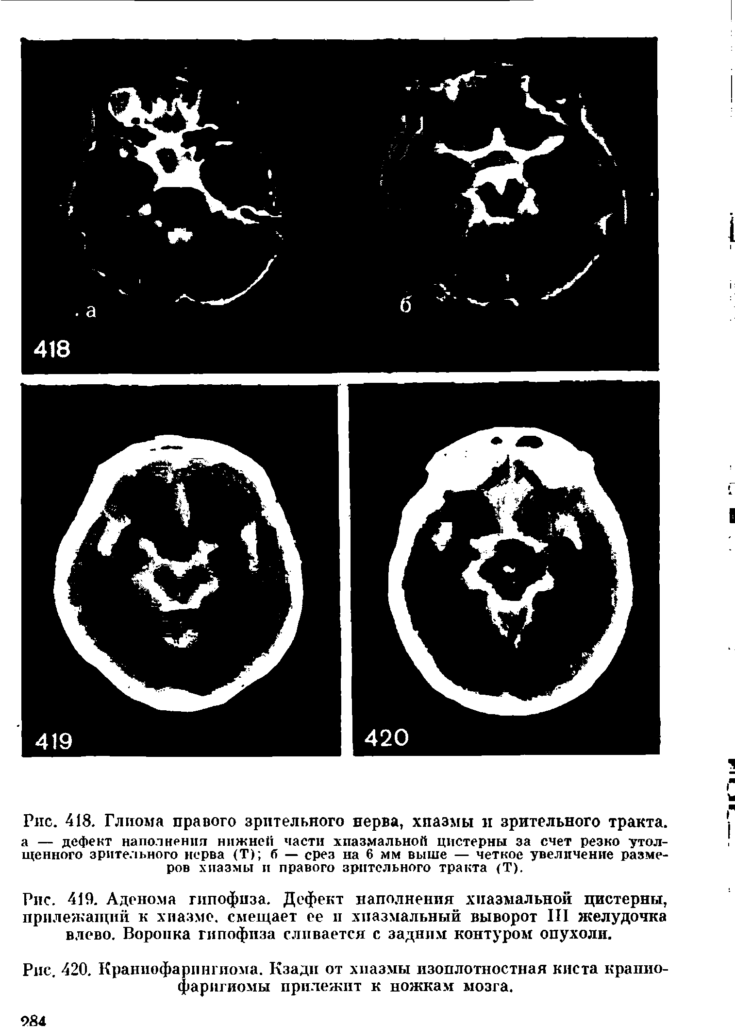 Рис. 418. Глиома правого зрительного нерва, хиазмы и зрительного тракта.. ...