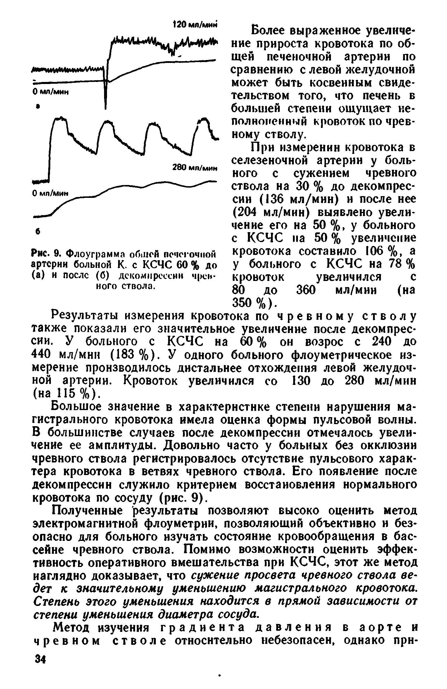 Рис. 9. Флоуграмма облей псчсгочиой артерии больной К. с КСЧС 60 % до (а) и после (б) декомпрессии чрев-ного ствола.