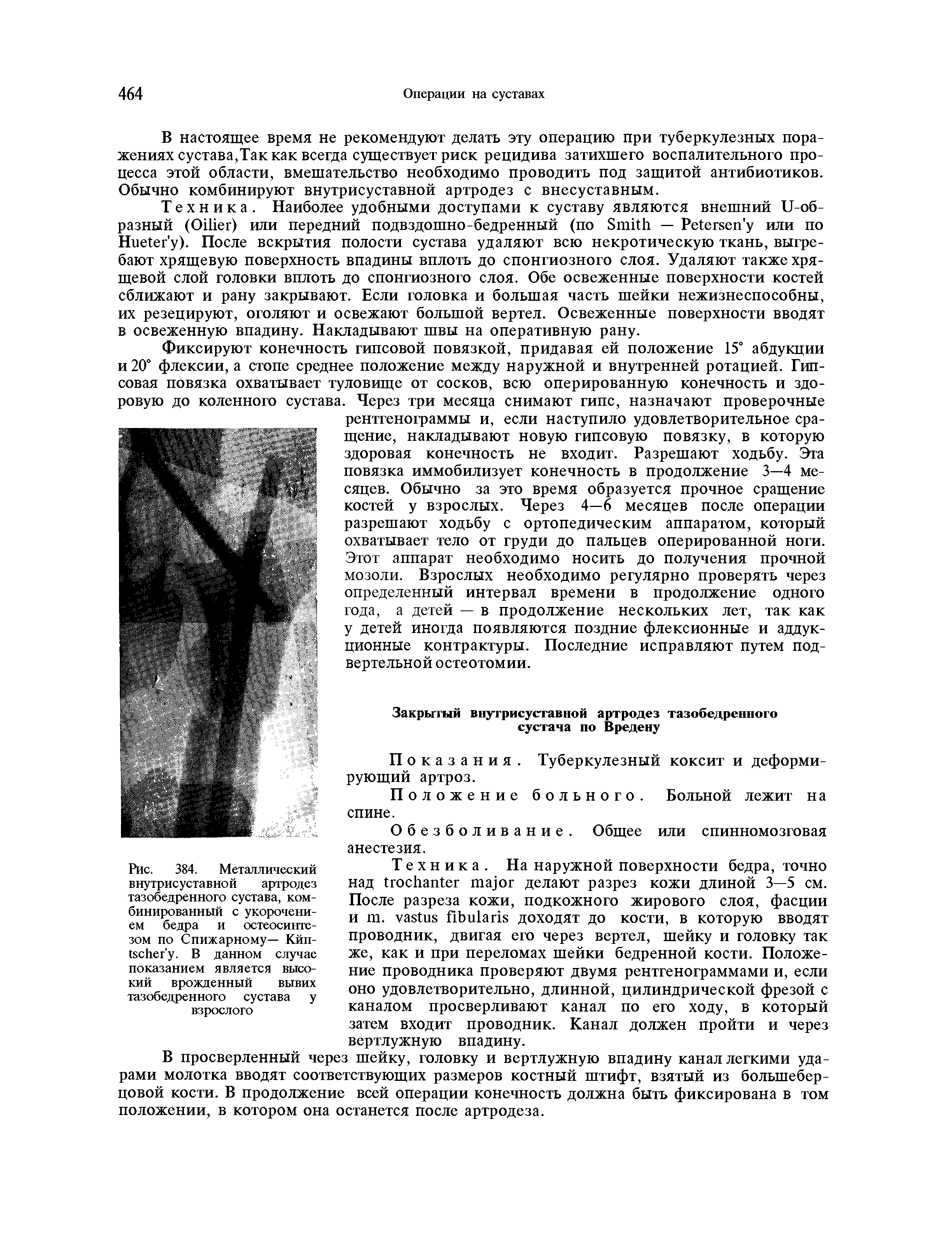 Рис. 384. Металлический внутрисуставной артродез тазобедренного сустава, комбинированный с укорочением бедра и остеосинтезом по Спижарному— Кйп-ГвсНег у. В данном случае показанием является высокий врожденный вывих тазобедренного сустава у взрослого...