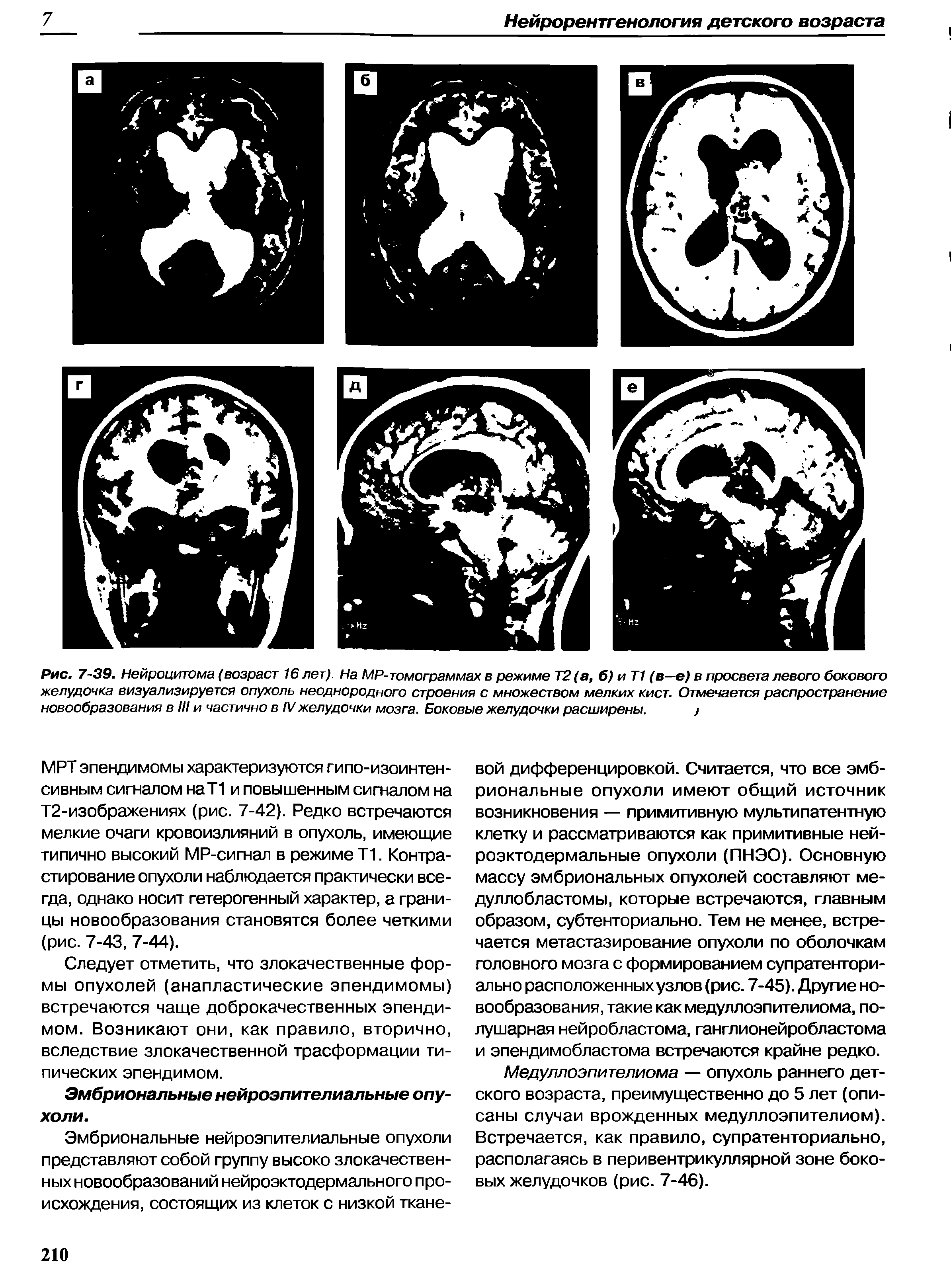 Рис. 7-39. Нейроцитома (возраст 16 лет) На MP-томограммах в режиме Т2 (а, б) и Т1 (в—е) в просвета левого бокового желудочка визуализируется опухоль неоднородного строения с множеством мелких кист. Отмечается распространение новообразования в III и частично в IVжелудочки мозга. Боковые желудочки расширены. ...