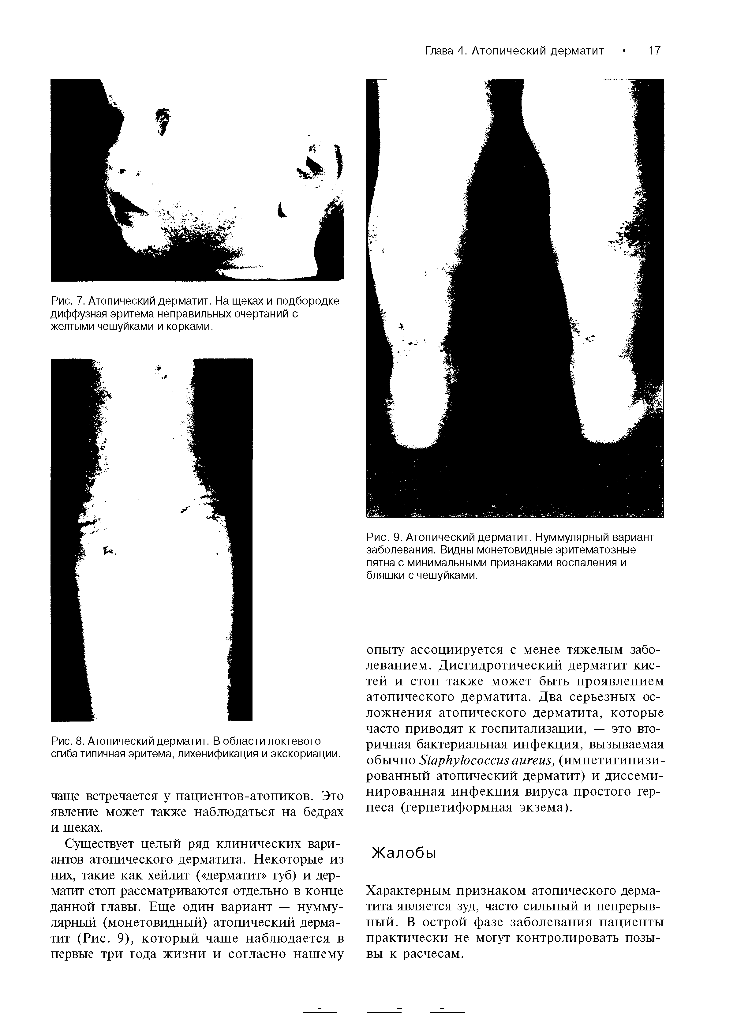 Рис. 9. Атопический дерматит. Нуммулярный вариант заболевания. Видны монетовидные эритематозные пятна с минимальными признаками воспаления и бляшки с чешуйками.