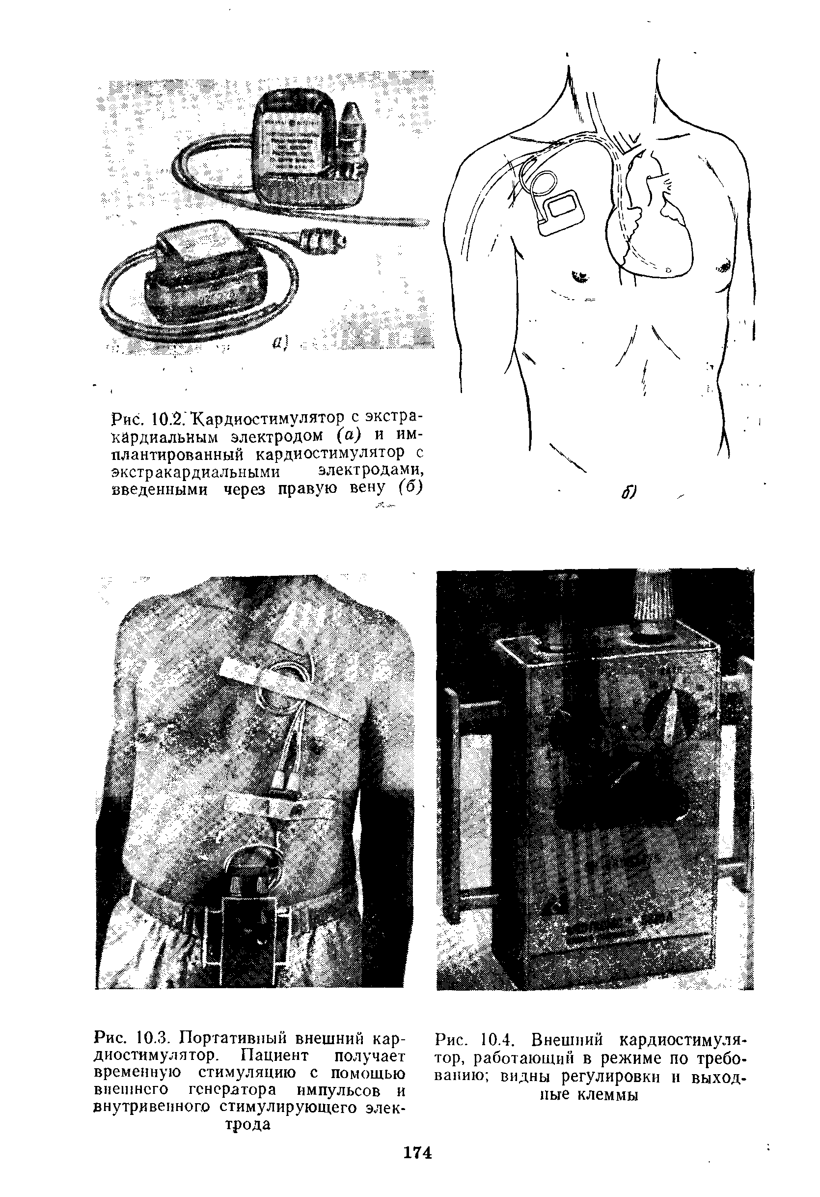 Рис. 10.3. Портативный внешний кардиостимулятор. Пациент получает временную стимуляцию с помощью внешнего генератора импульсов и внутривенного стимулирующего электрода...