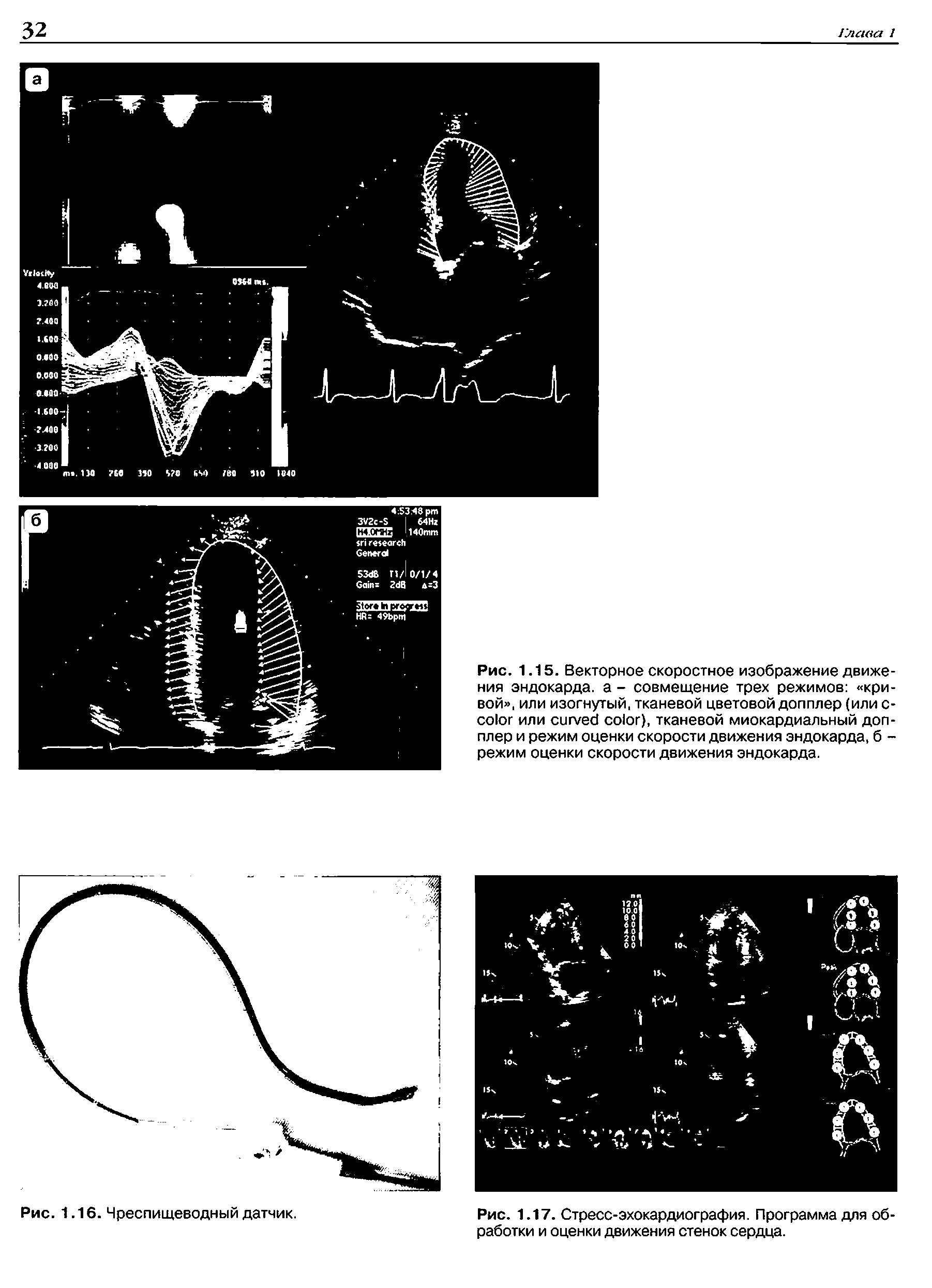 Рис. 1.15. Векторное скоростное изображение движения эндокарда, а - совмещение трех режимов кривой , или изогнутый, тканевой цветовой допплер (или с- или ), тканевой миокардиальный допплер и режим оценки скорости движения эндокарда, б -режим оценки скорости движения эндокарда.