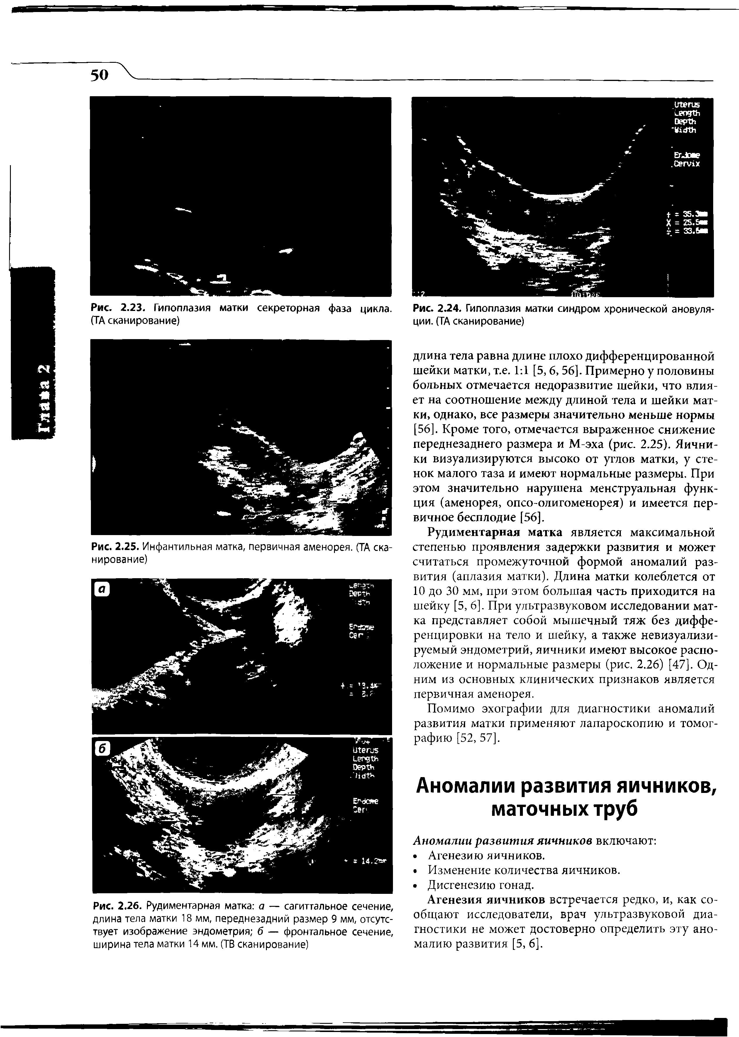 Рис. 2.23. Гипоплазия матки секреторная фаза цикла. (ТА сканирование)...