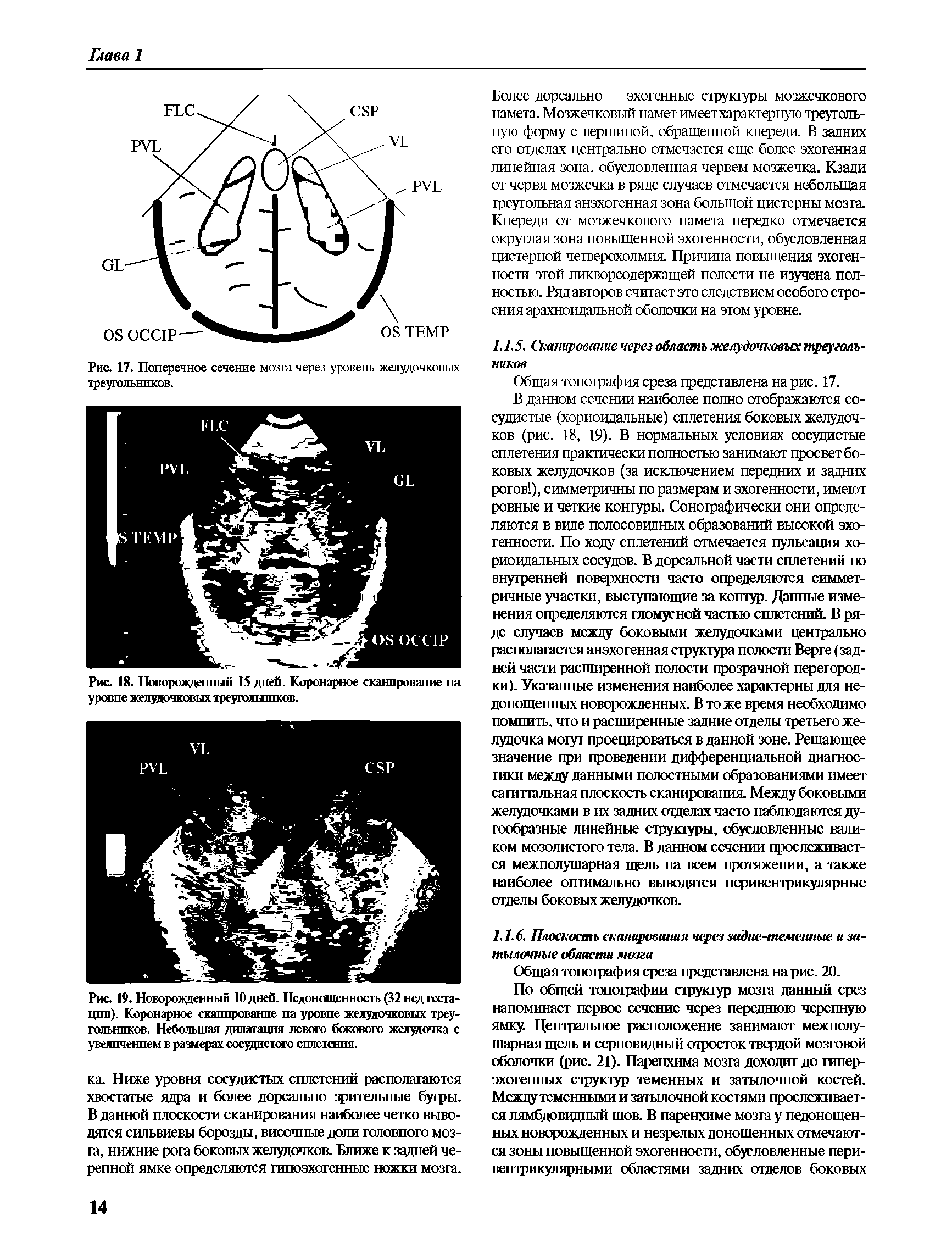 Рис. 19. Новорожденный 10 дней. Недоношенность (32 нед гестации). Коронарное сканирование на уровне желудочковых треугольников. Небольшая дипятяцгтя левого бокового желудочка с увеличением в размерах сосудистого сплетения.