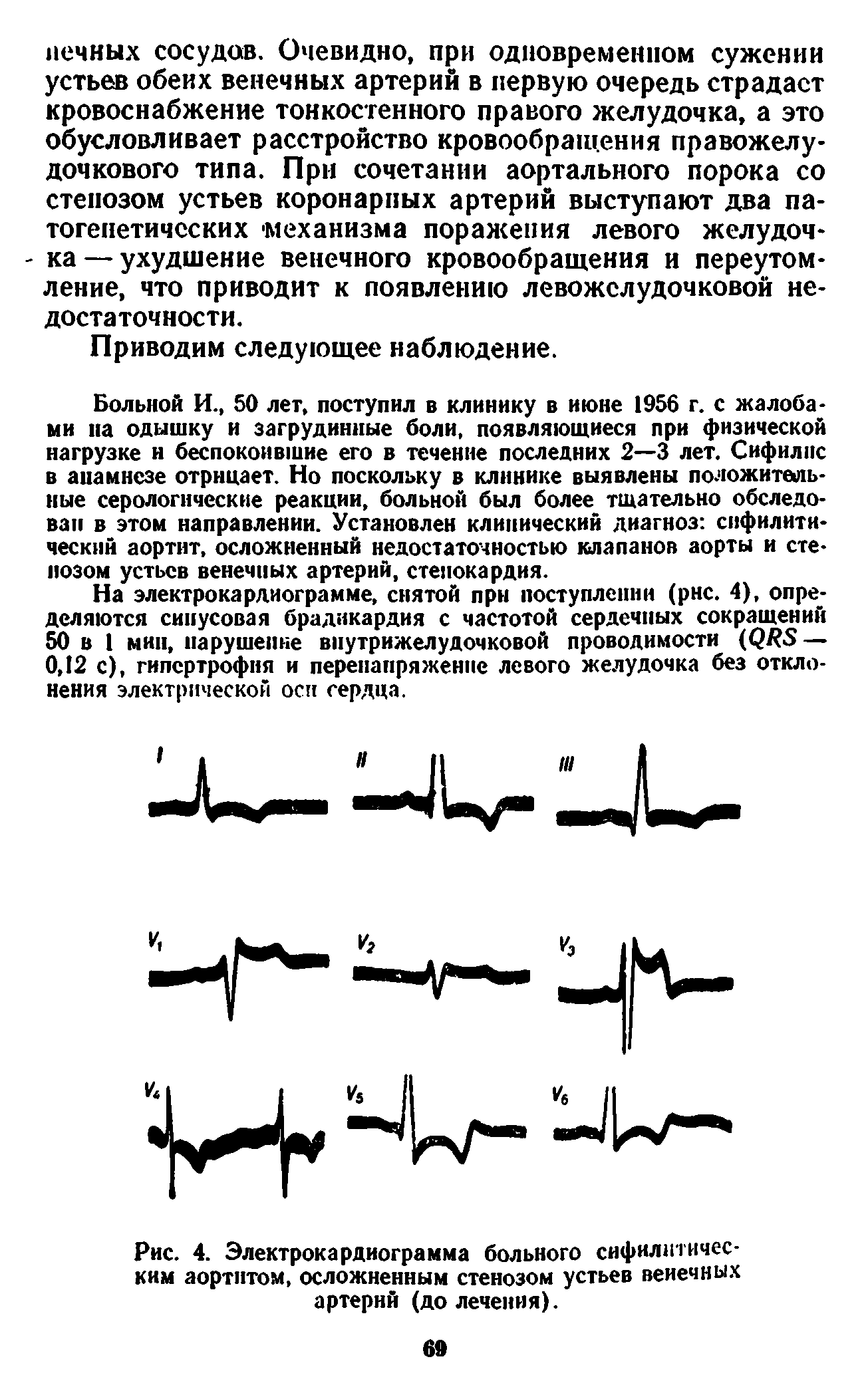 Рис. 4. Электрокардиограмма больного сифилитическим аортитом, осложненным стенозом устьев венечных артерий (до лечения).