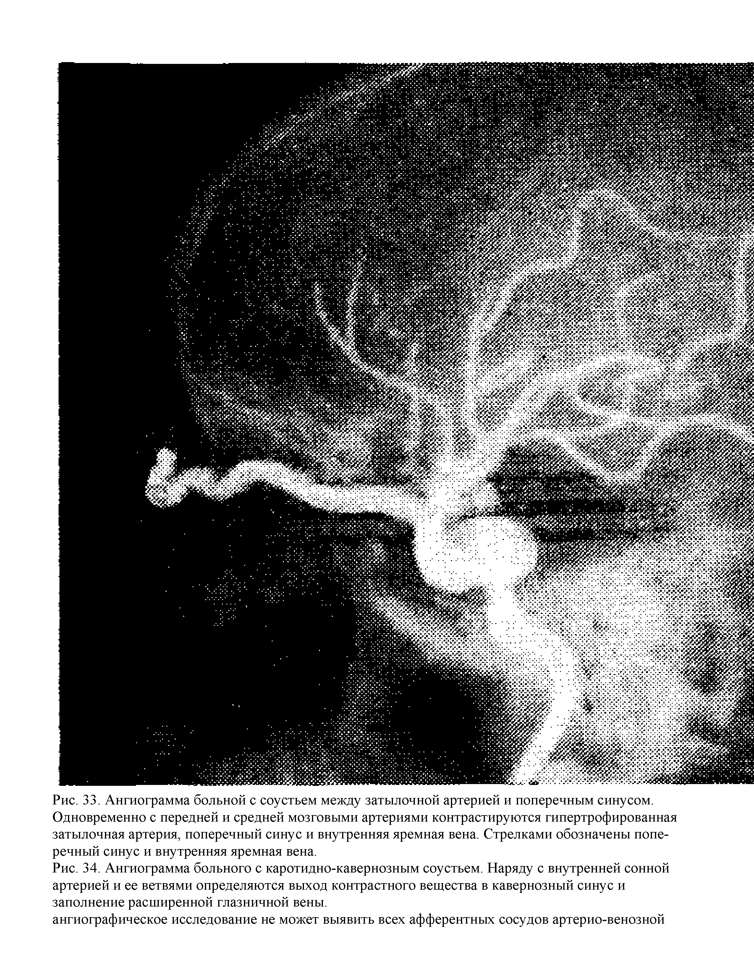 Рис. 34. Ангиограмма больного с каротидно-кавернозным соустьем. Наряду с внутренней сонной артерией и ее ветвями определяются выход контрастного вещества в кавернозный синус и заполнение расширенной глазничной вены.