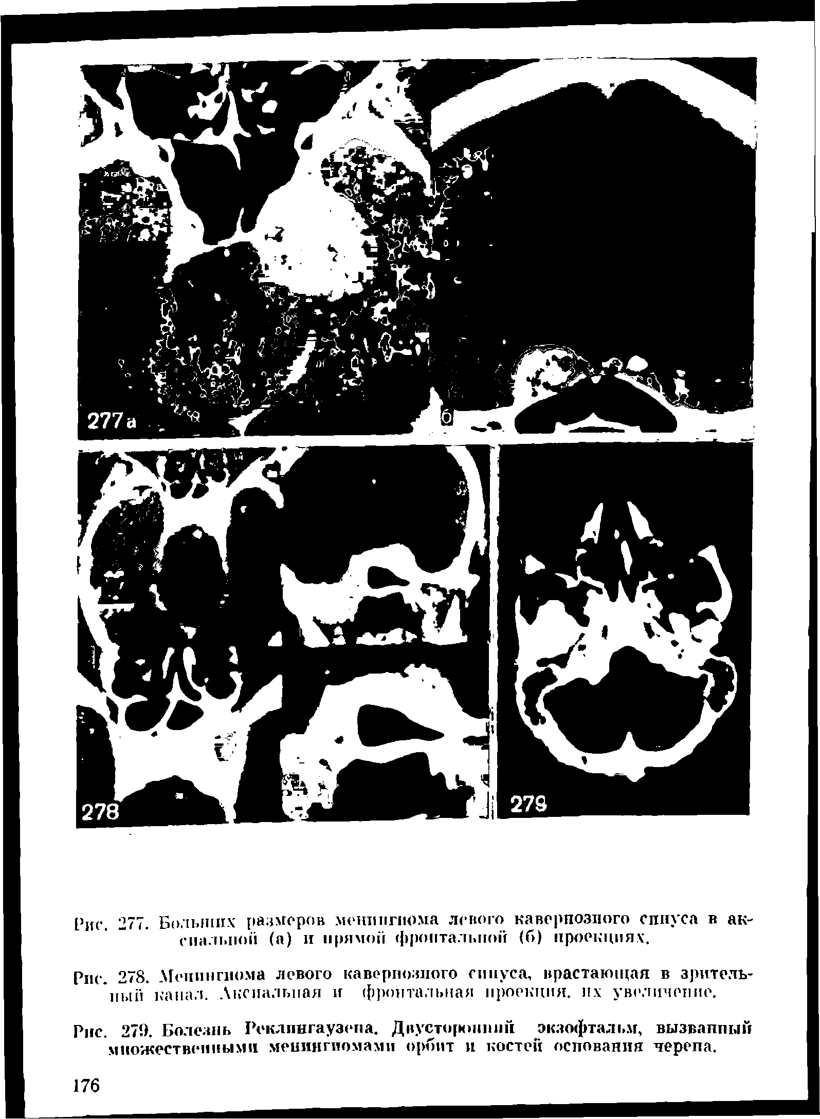 Рис. 278. Менингиома левого кавернозного синуса, врастающая в зрительный канал. Аксиальная и фронтальная проекция, их увеличение.