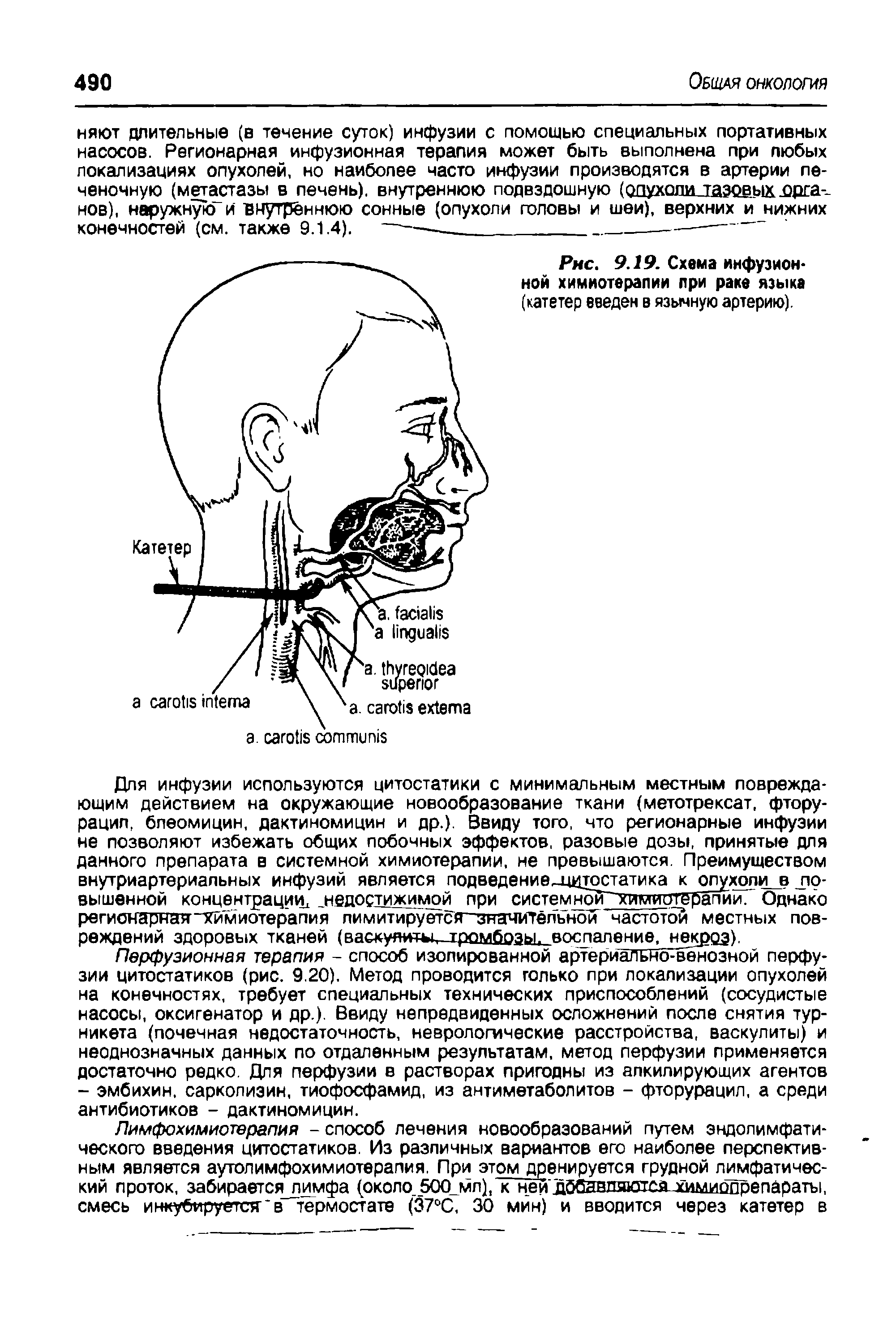 Рис. 9.19. Схема инфузионной химиотерапии при раке языка (катетер введен в язычную артерию).