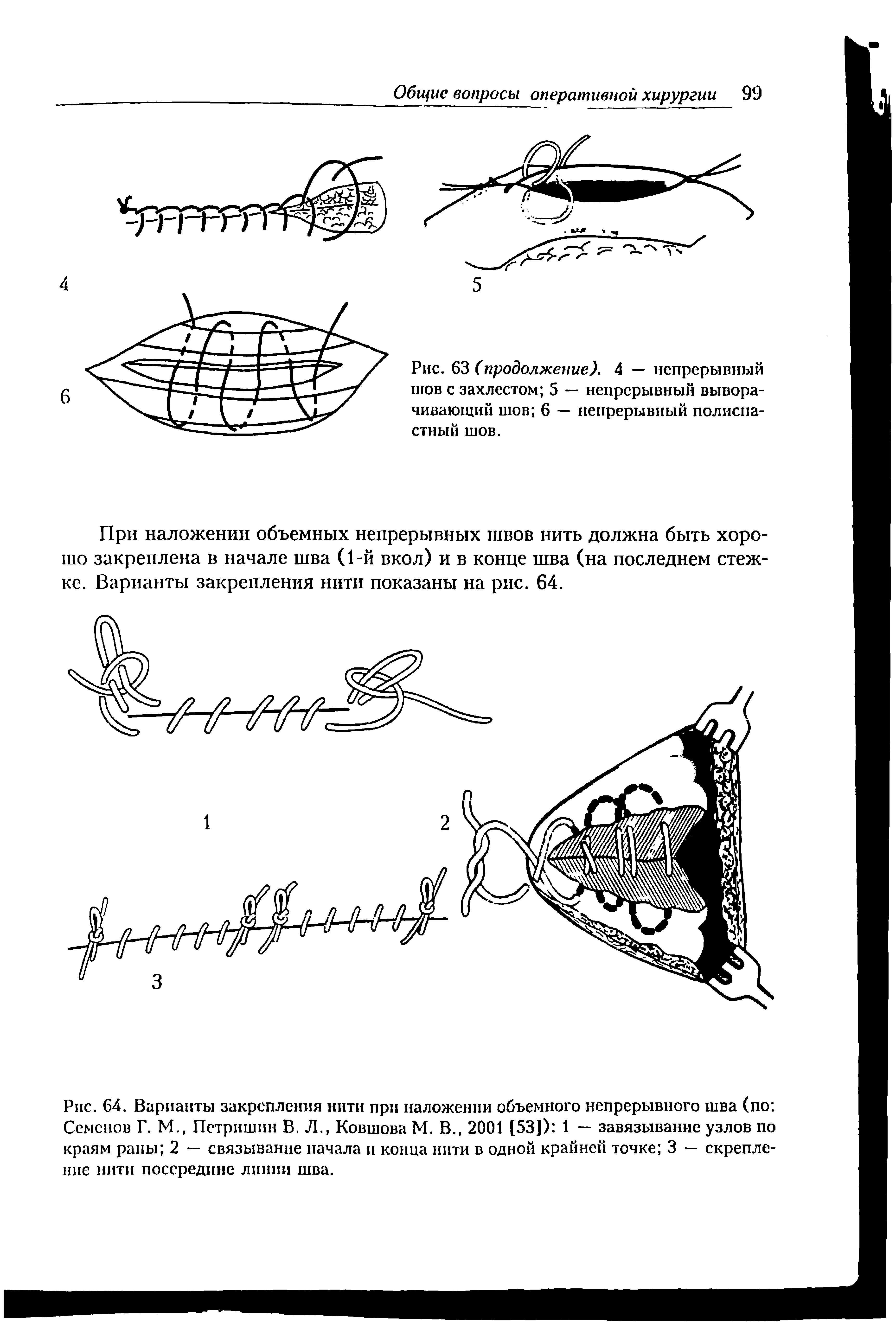 Рис. 64. Варианты закрепления нити при наложении объемного непрерывного шва (по Семенов Г. М. Петришин В. Л., Ковшова М. В., 2001 [53]) 1 — завязывание узлов по краям раны 2 — связывание начала и конца нити в одной крайней точке 3 — скрепление нити посередине линии шва.