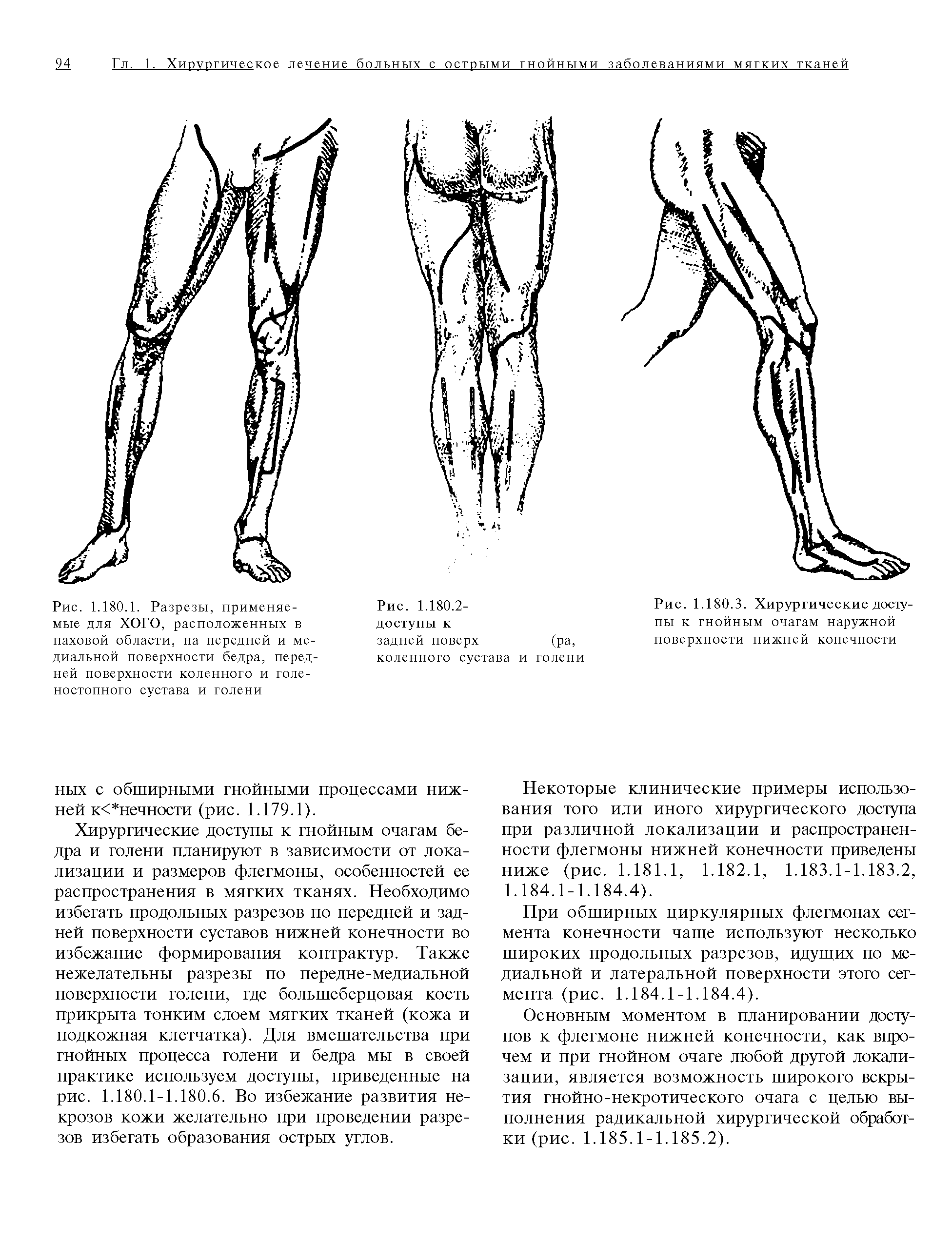 Рис. 1.180.1. Разрезы, применяемые для ХОГО, расположенных в паховой области, на передней и медиальной поверхности бедра, передней поверхности коленного и голеностопного сустава и голени...