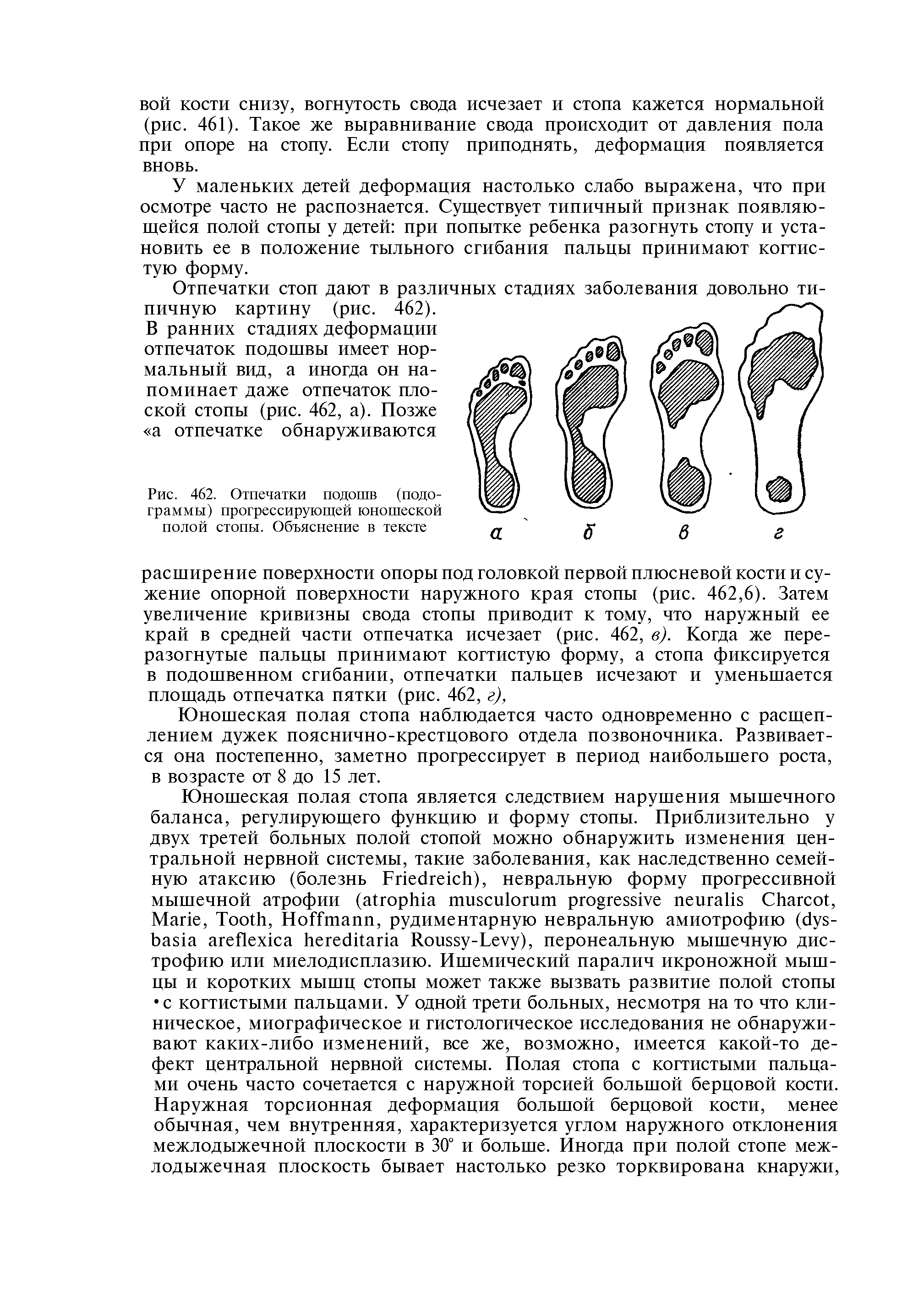 Рис. 462. Отпечатки подошв (иодограммы) прогрессирующей юношеской полой стопы. Объяснение в тексте...