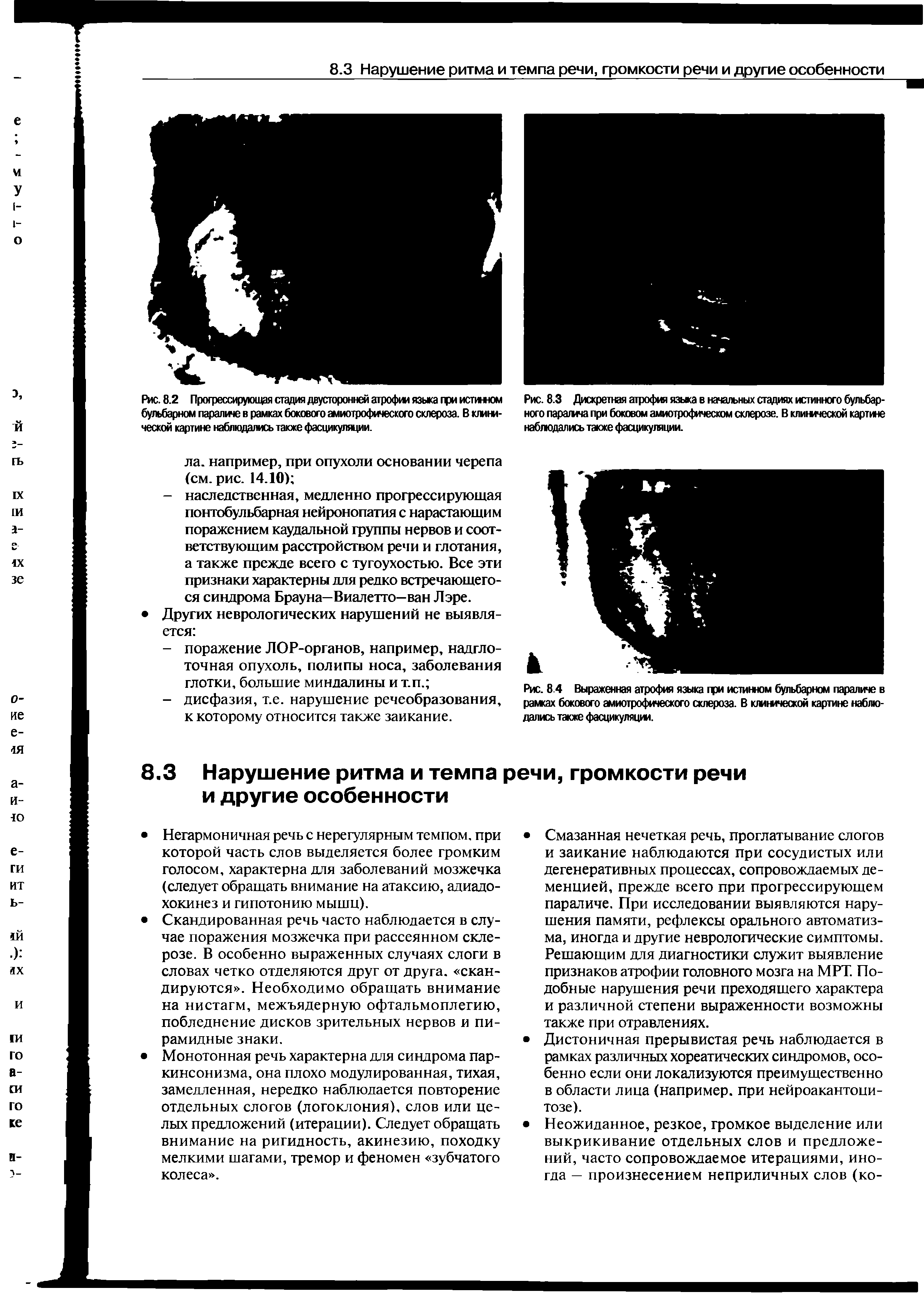 Рис. 84 Выраженная атрофия языка трт истинном бульбарном параличе в рамках бокового амиотрофического склероза. В клитыческой картине наблюдались также фасцикуляции.