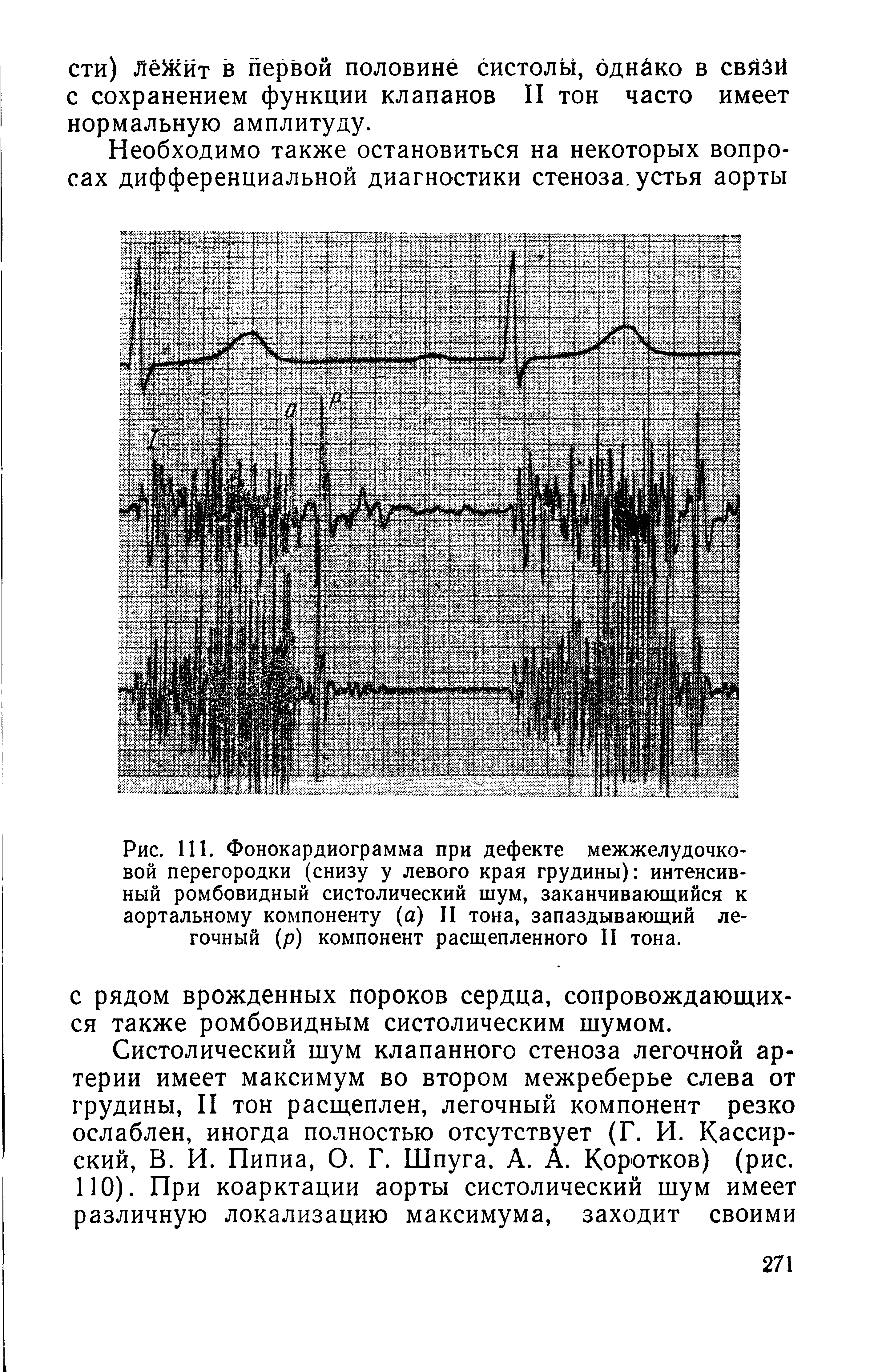 Рис. 111. Фонокардиограмма при дефекте межжелудочковой перегородки (снизу у левого края грудины) интенсивный ромбовидный систолический шум, заканчивающийся к аортальному компоненту (а) II тона, запаздывающий легочный (р) компонент расщепленного II тона.