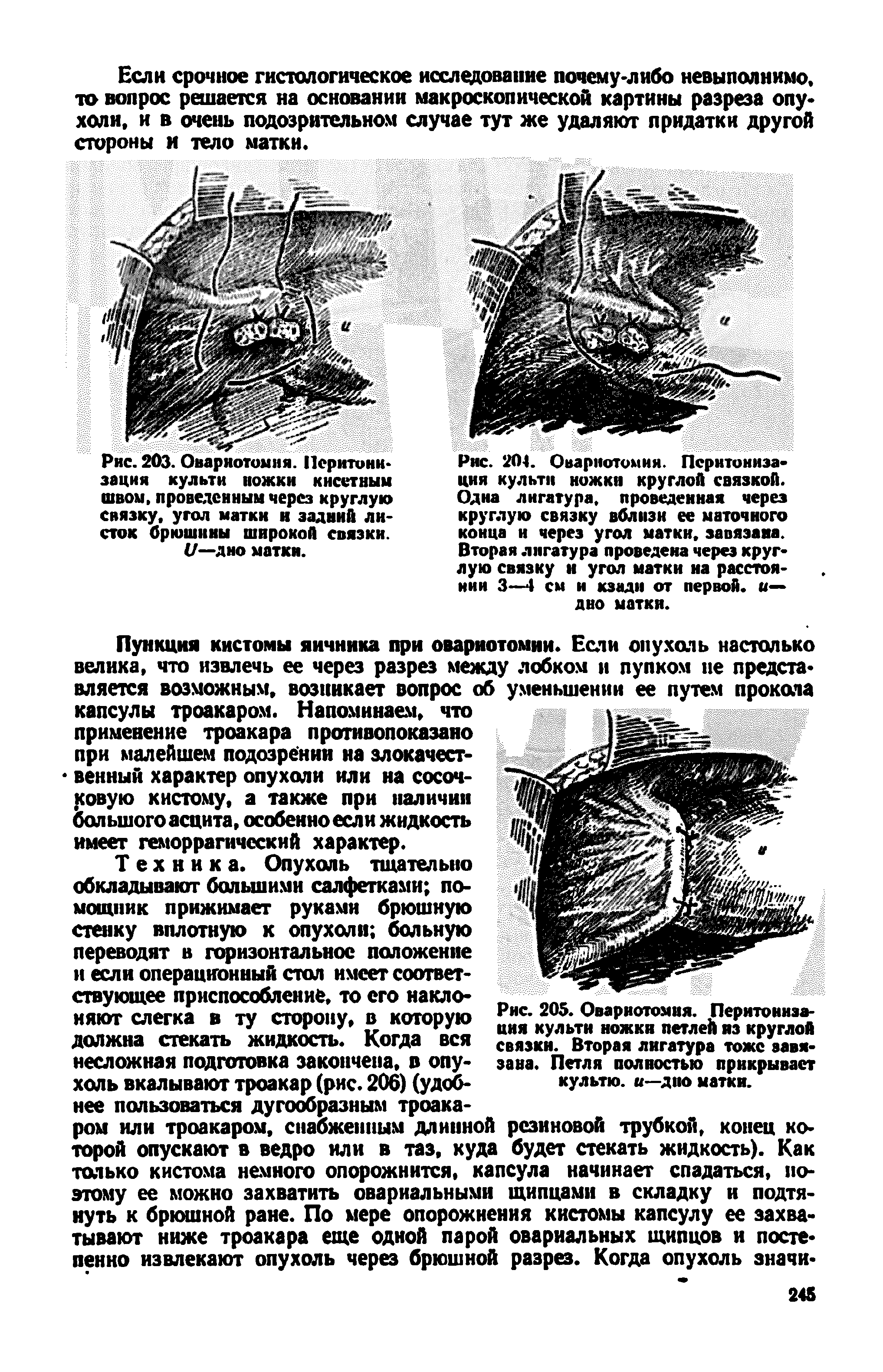 Рис. 204. Овариотомия. Псрнтониэа-ция культи ножки круглой связкой. Одна лигатура, проведенная через круглую связку вблизи ее маточного конца и через угол матки, завязана. Вторая лигатура проведена через круглую связку и угол матки на расстоянии 3—4 см и кзади от первой, и— дно матки.