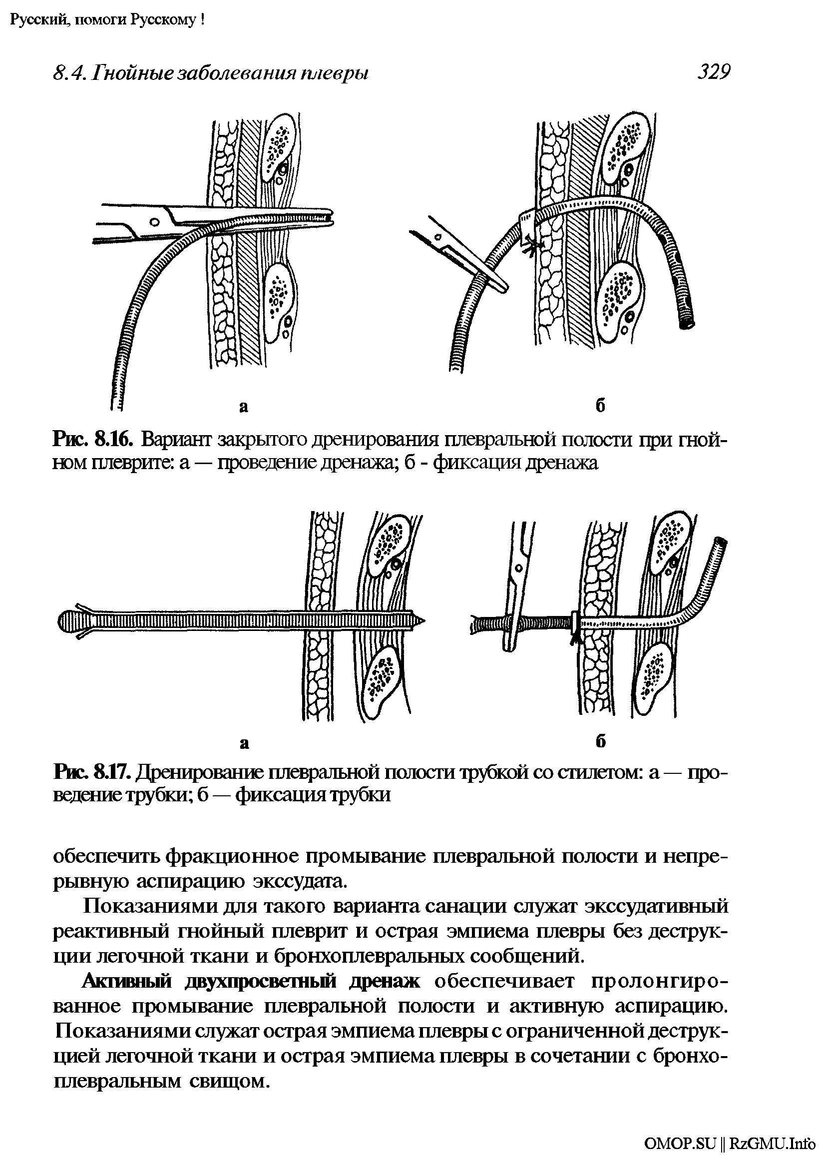 Рис. 8.16. Вариант закрытого дренирования плевральной полости при гнойном плеврите а — проведение дренажа б - фиксация дренажа...