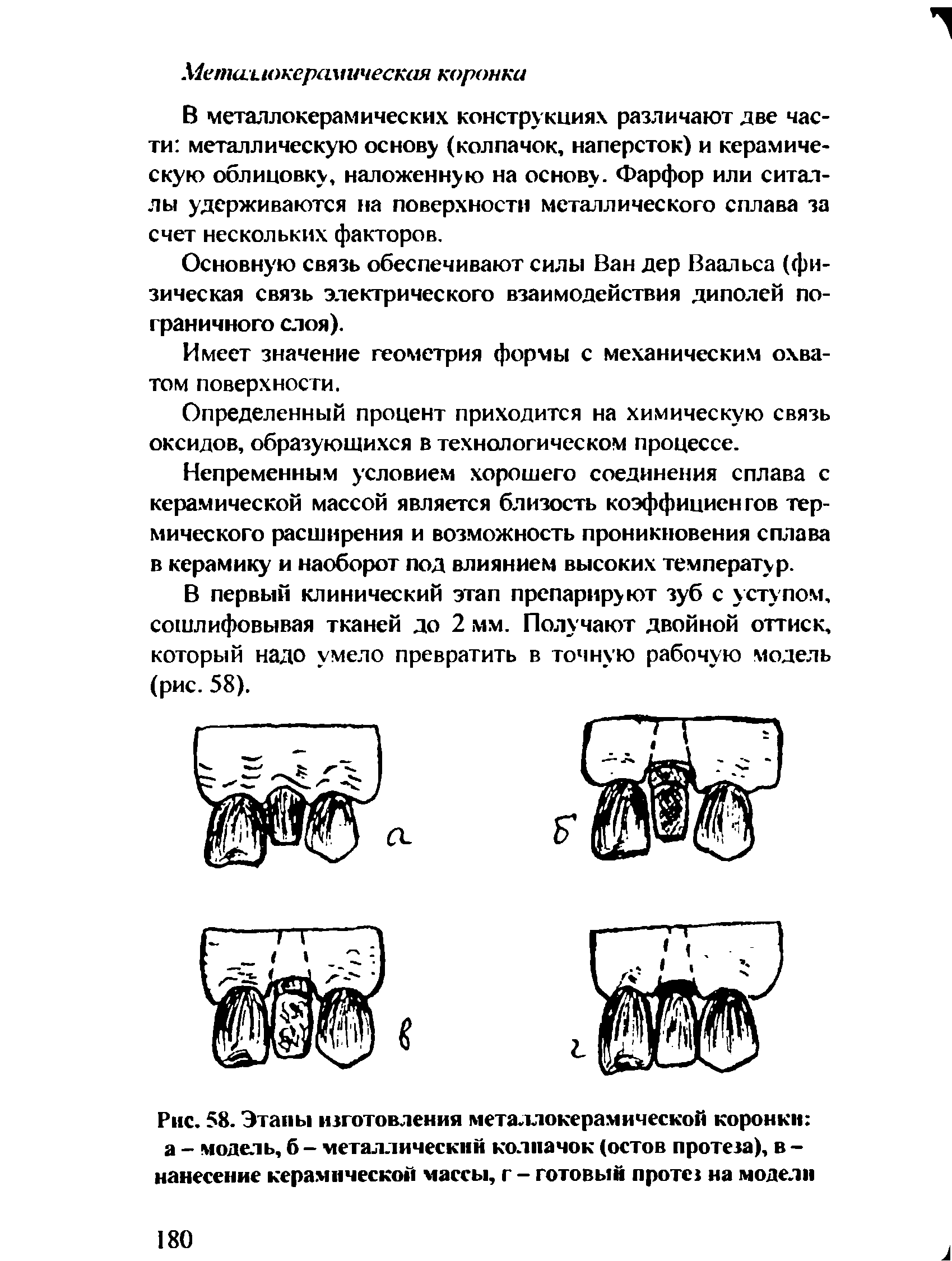 Рис. 58. Этапы изготовления металлокерамической коронки а - модель, б - металлический колпачок (остов протеза), в -нанесение керамической массы, г - готовый протез на модели...