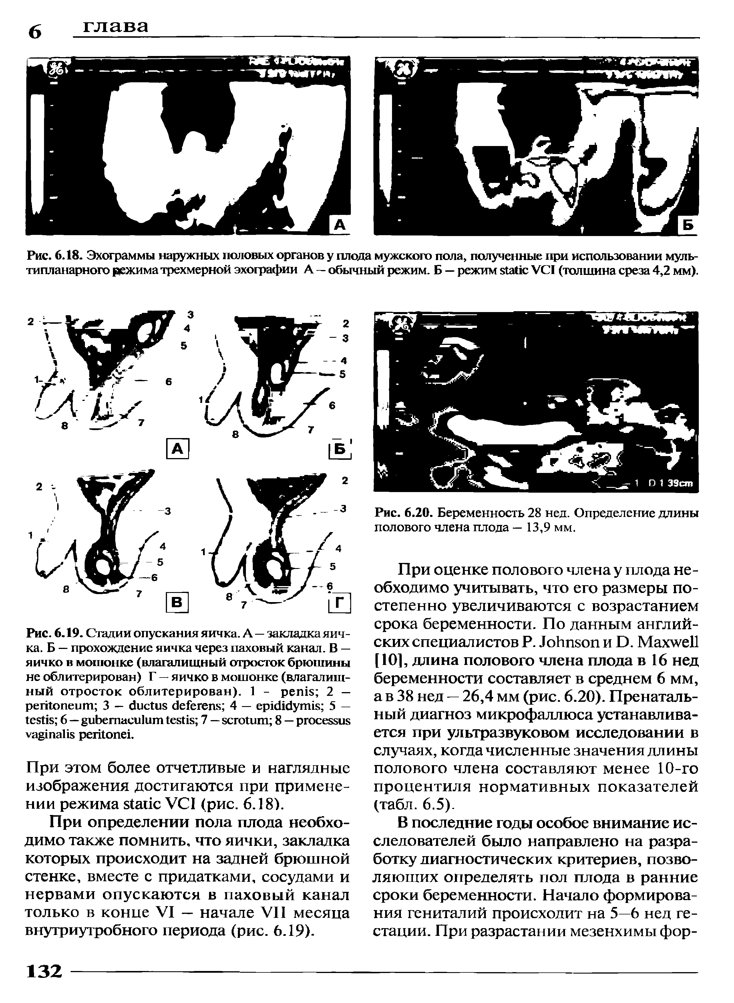 Рис. 6.18. Эхограммы наружных половых органов у плода мужского пола, полученные при использовании муль-типланарного режима трехмерной эхографии А — обычный режим. Б — режим VCI (толщина среза 4,2 мм).