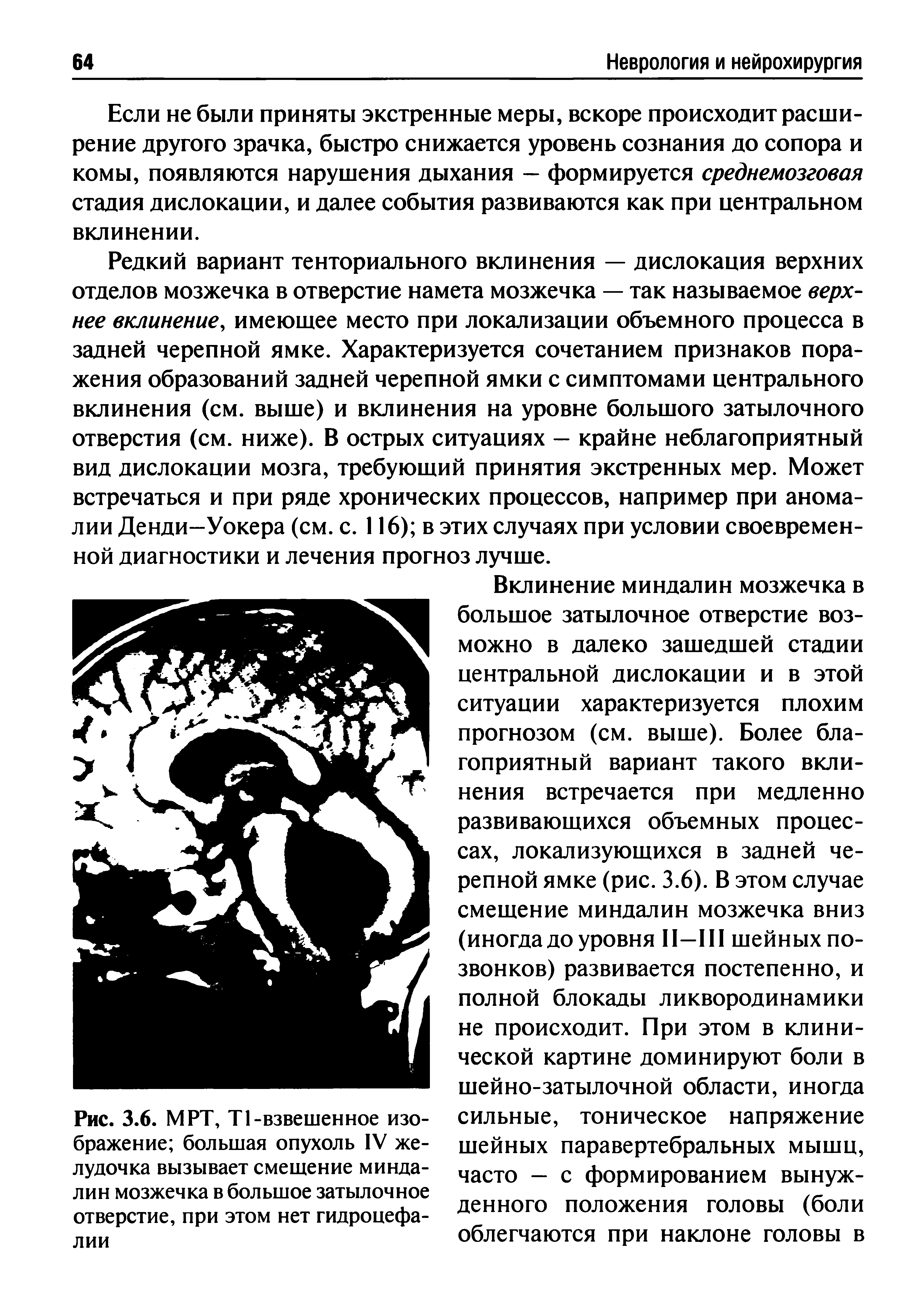 Рис. 3.6. МРТ, Т1-взвешенное изображение большая опухоль IV желудочка вызывает смешение миндалин мозжечка в большое затылочное отверстие, при этом нет гидроцефалии...