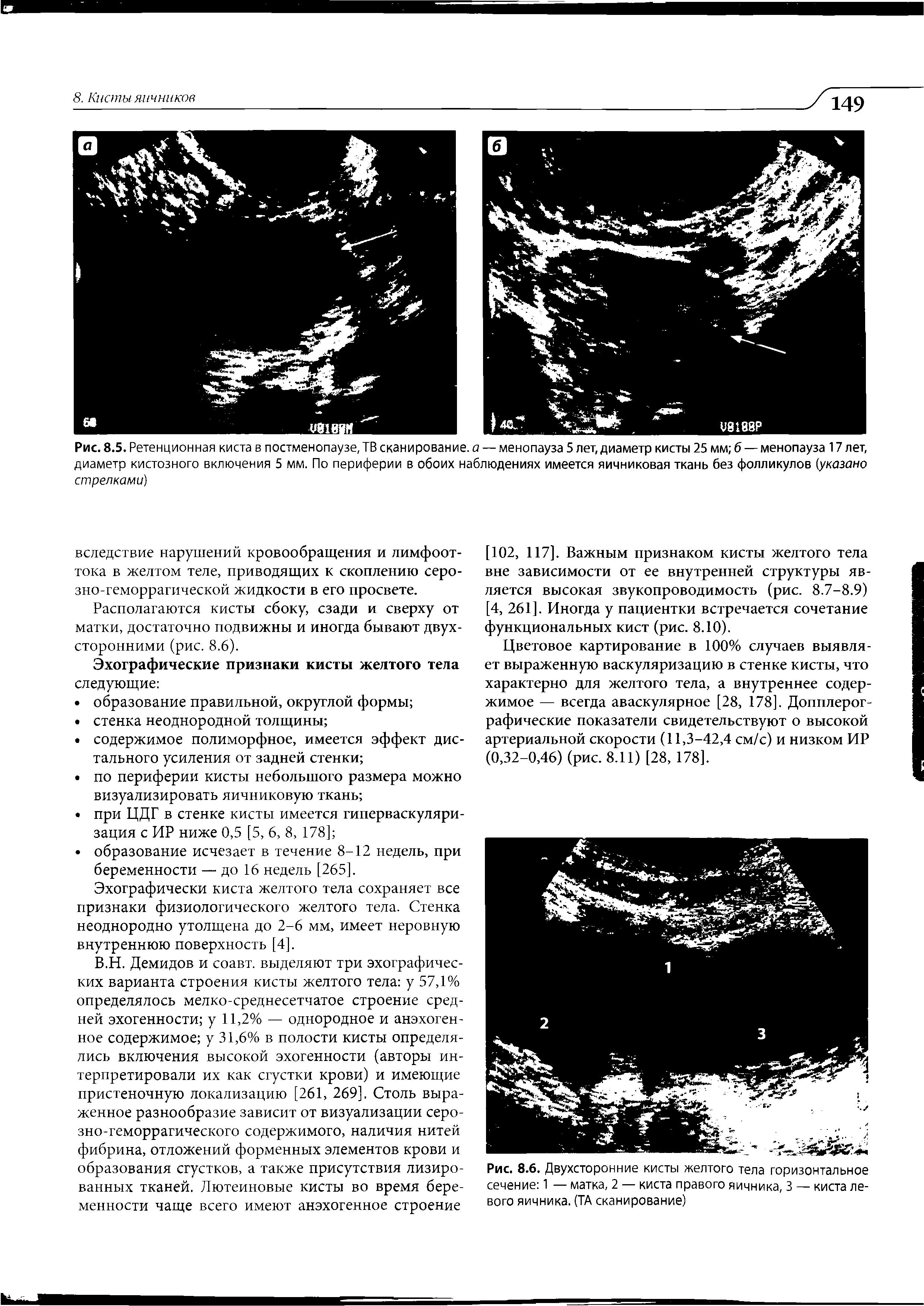 Рис. 8.6. Двухсторонние кисты желтого тела горизонтальное сечение 1 — матка, 2 — киста правого яичника, 3 — киста левого яичника. (ТА сканирование)...