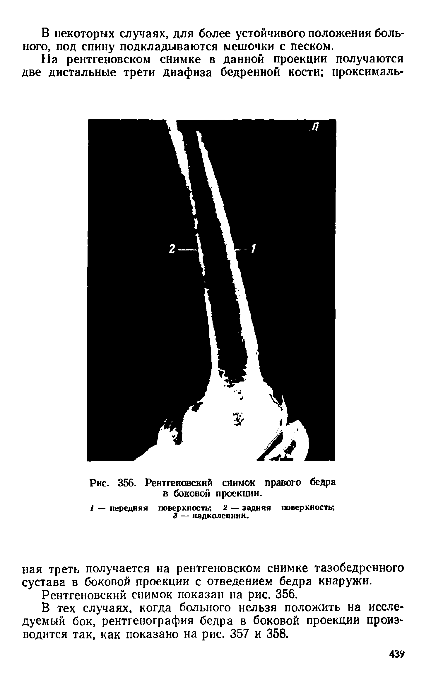 Рис. 356. Рентгеновский снимок правого бедра в боковой проекции.