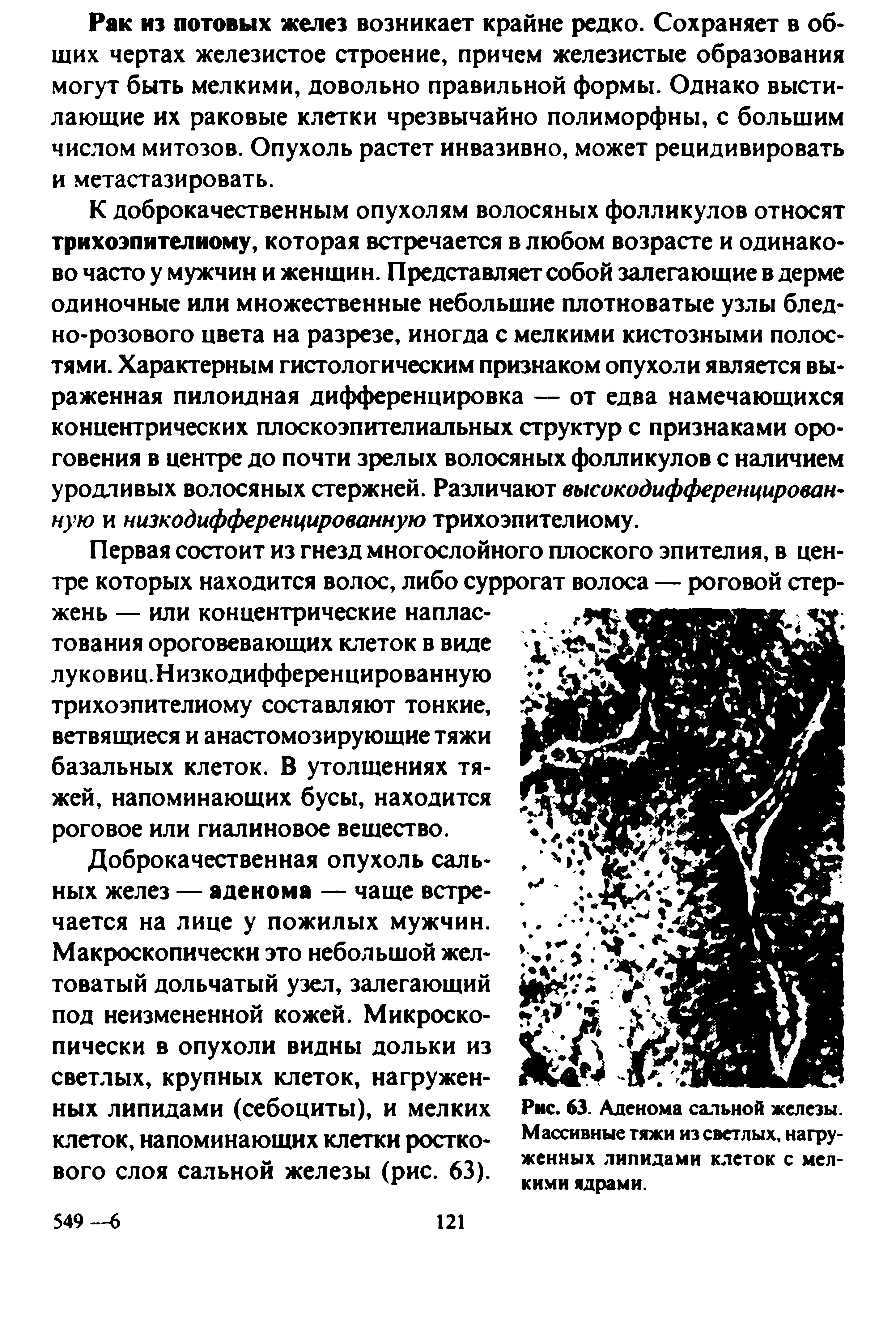 Рис. 63. Аденома сальной железы. Массивные тяжи из светлых, нагруженных липидами клеток с мелкими ядрами.