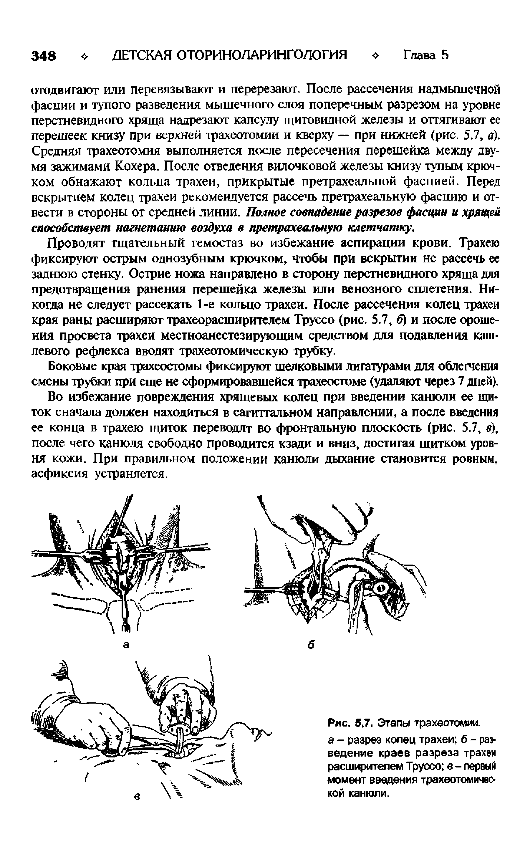 Рис. 5.7. Этапы трахеотомии. а - разрез колец трахеи б - раз-ведение краев разреза трахеи расширителем Труссо в - первый момент введения трахеотомической канюли.